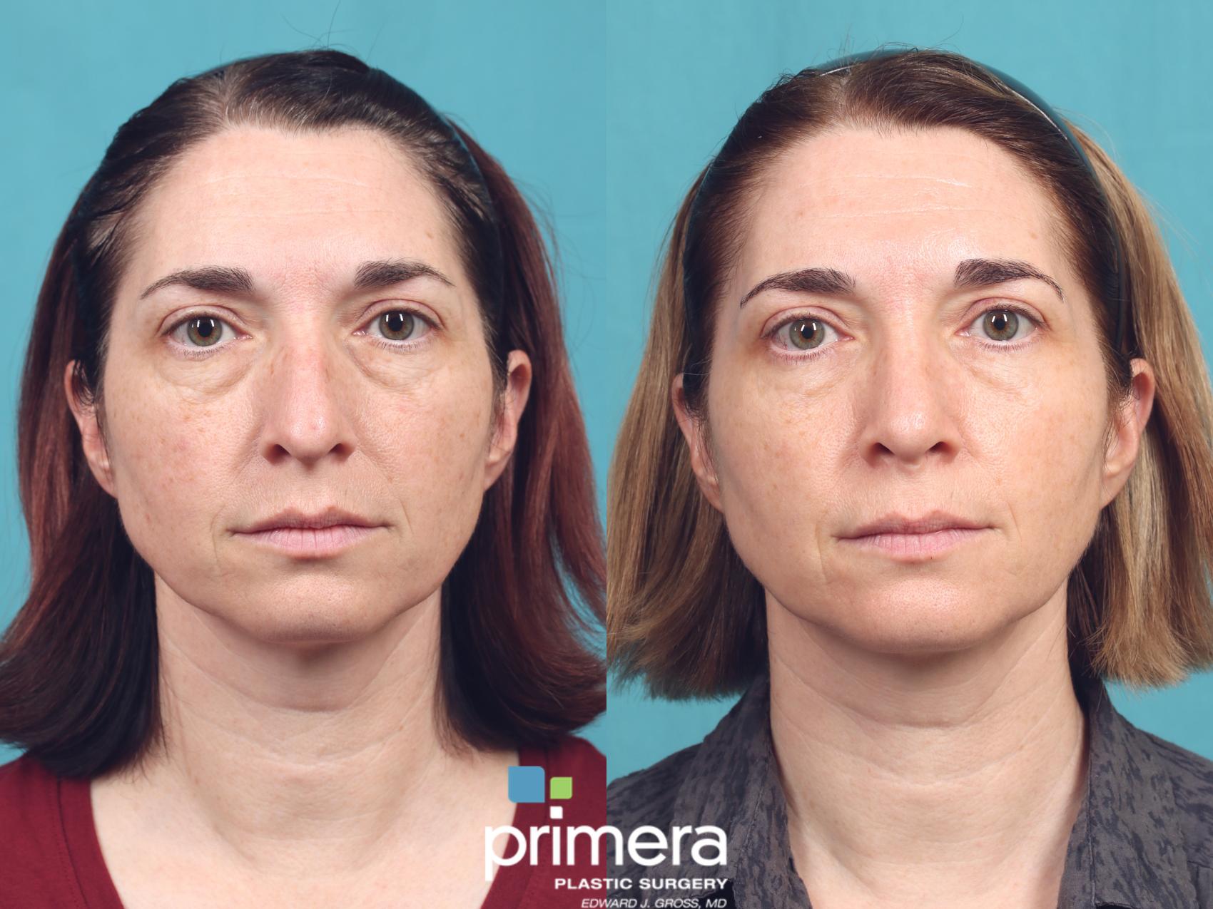 Before & After Blepharoplasty Case 1013 Front View in Orlando, Winter Park & Tampa, Florida