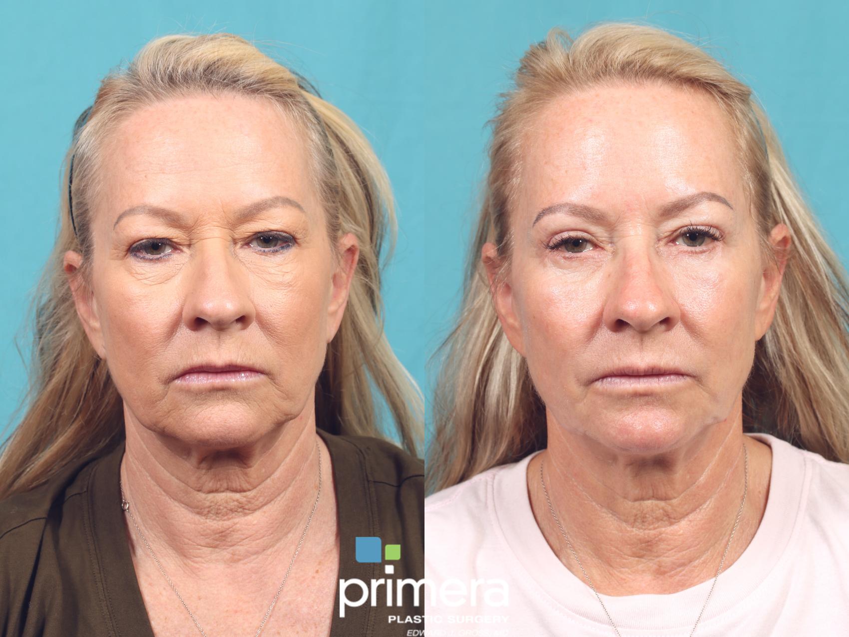 Before & After Blepharoplasty Case 1016 Front View in Orlando, Winter Park & Tampa, Florida