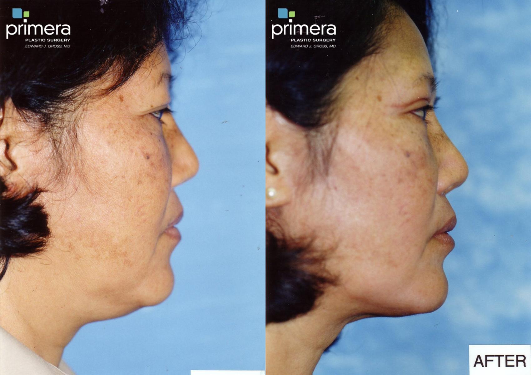 Blepharoplasty Before & After Photo | Orlando, Florida | Primera Plastic Surgery
