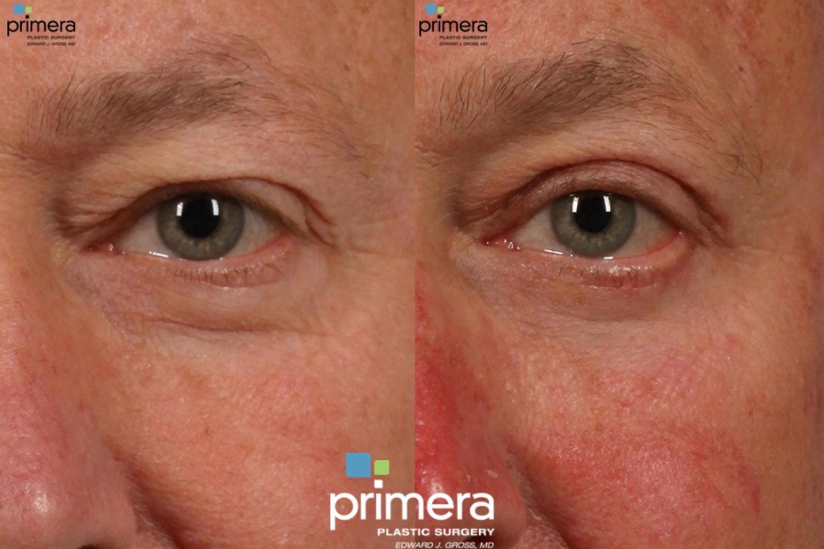 Before & After Blepharoplasty Case 14 view-1 View in Orlando, Florida