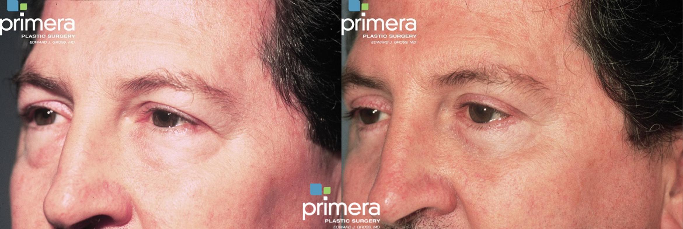 Blepharoplasty Before & After Photo | Orlando, Florida | Primera Plastic Surgery