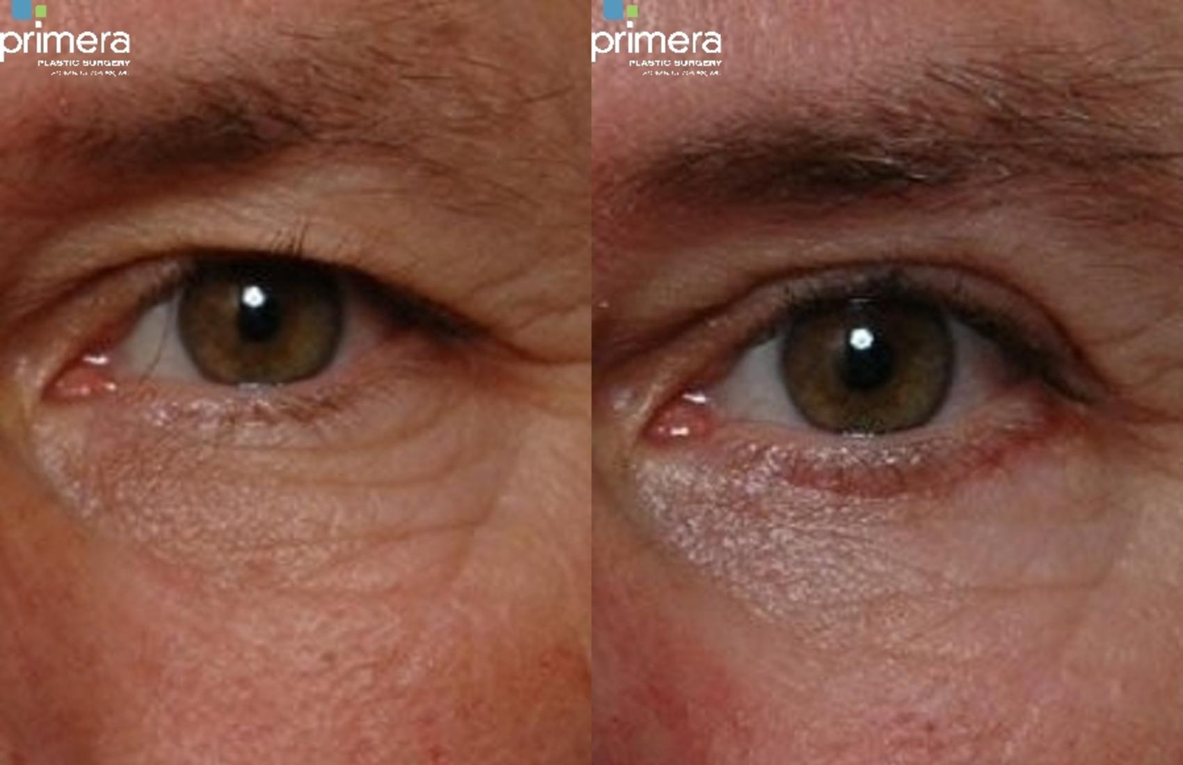 Before & After Blepharoplasty Case 251 view-1 View in Orlando, Florida