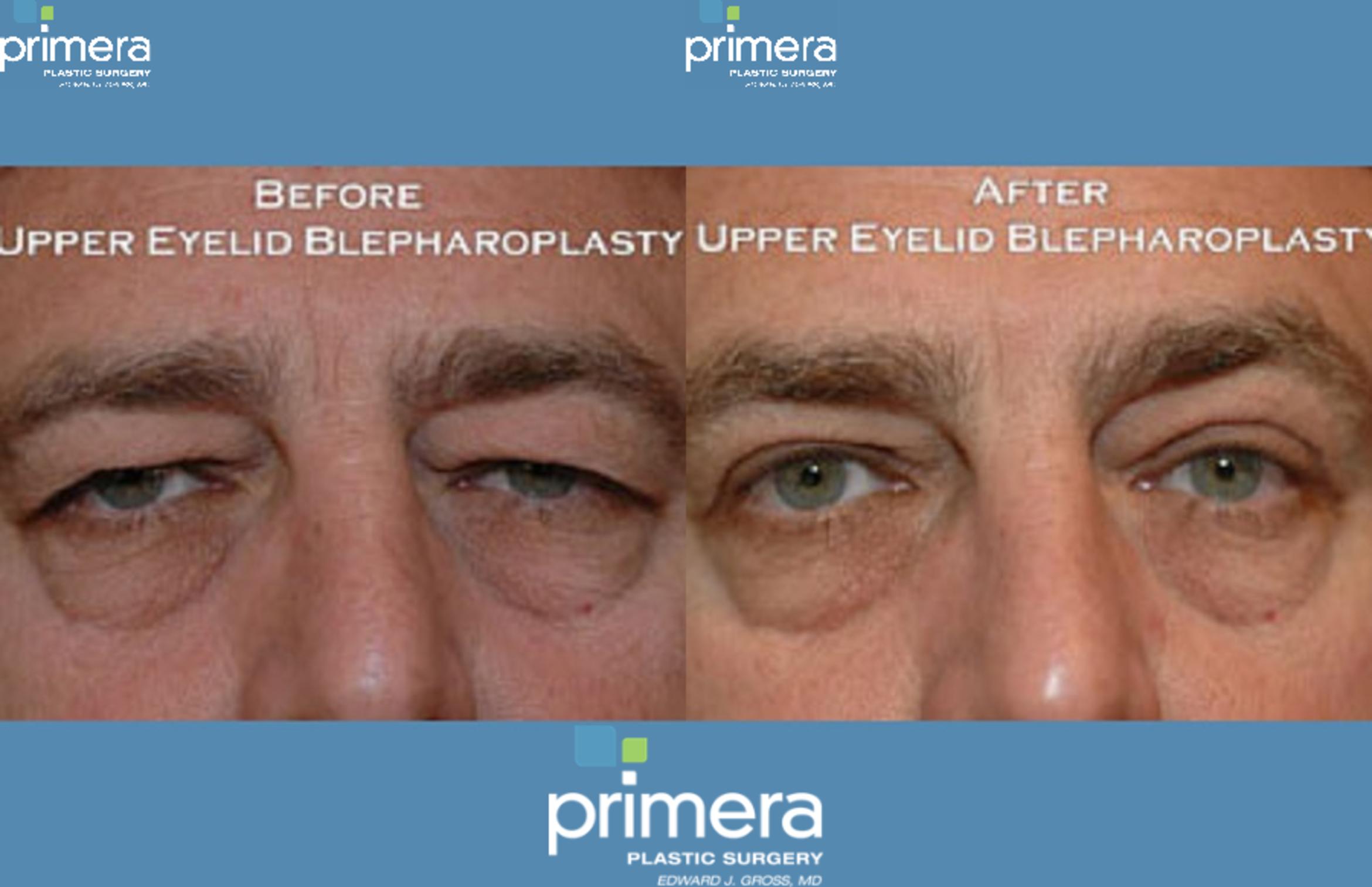 Blepharoplasty Before & After Photo | Orlando, Florida | Primera Plastic Surgery