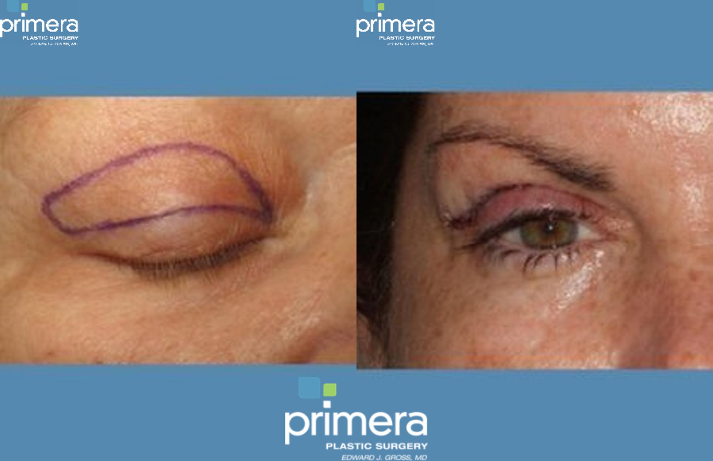 Blepharoplasty Before & After Photo | Orlando, Florida | Primera Plastic Surgery