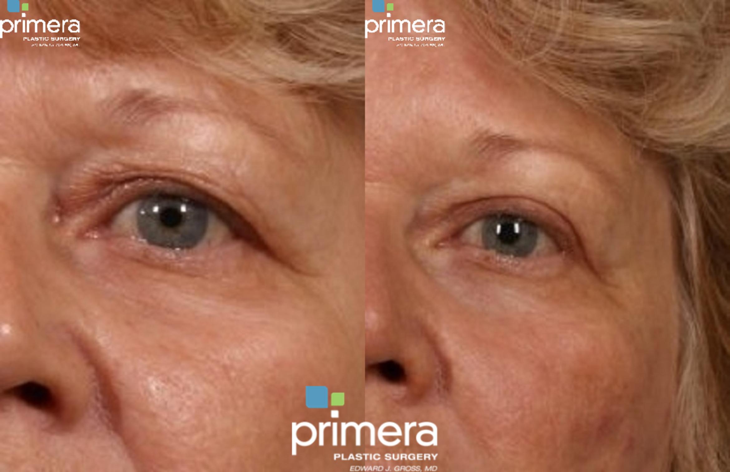 Blepharoplasty Before & After Photo | Orlando, Florida | Primera Plastic Surgery