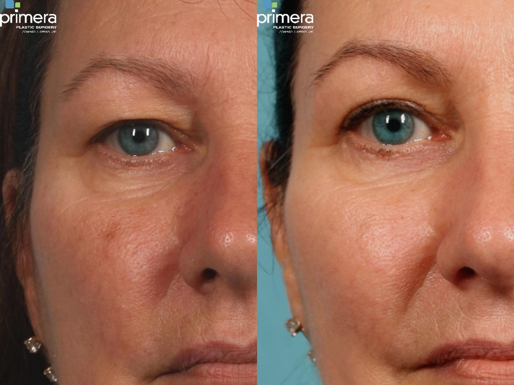 Before & After Blepharoplasty Case 288 view-1 View in Orlando, Florida