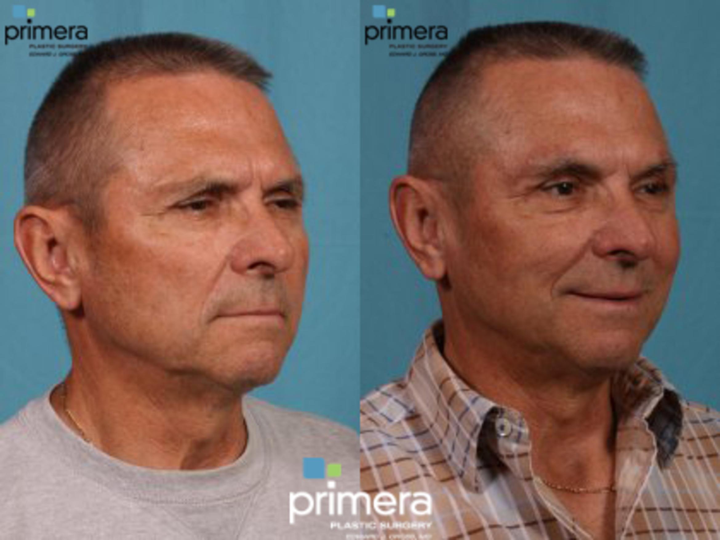 Brow Lift Before & After Photo | Orlando, Florida | Primera Plastic Surgery