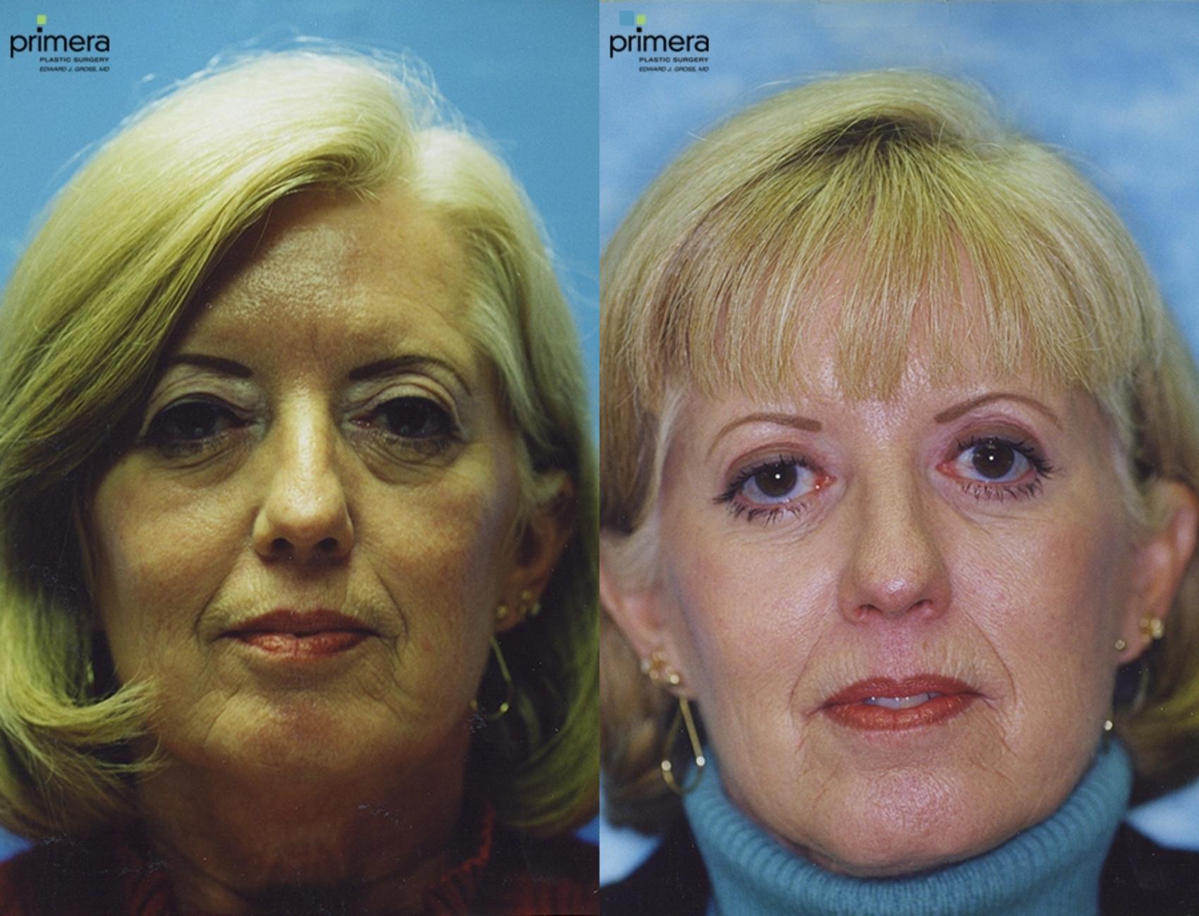 Blepharoplasty Before & After Photo | Orlando, Florida | Primera Plastic Surgery