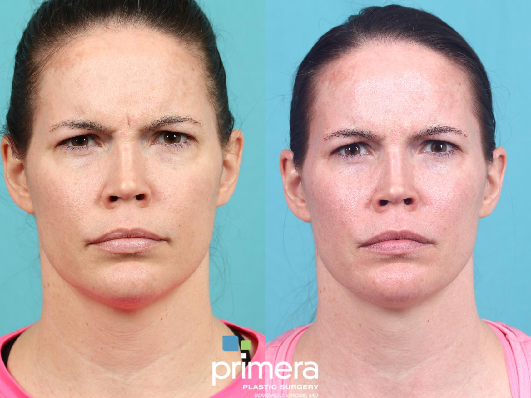 Before & After BOTOX® Cosmetic Case 950 Front View in Orlando, Florida
