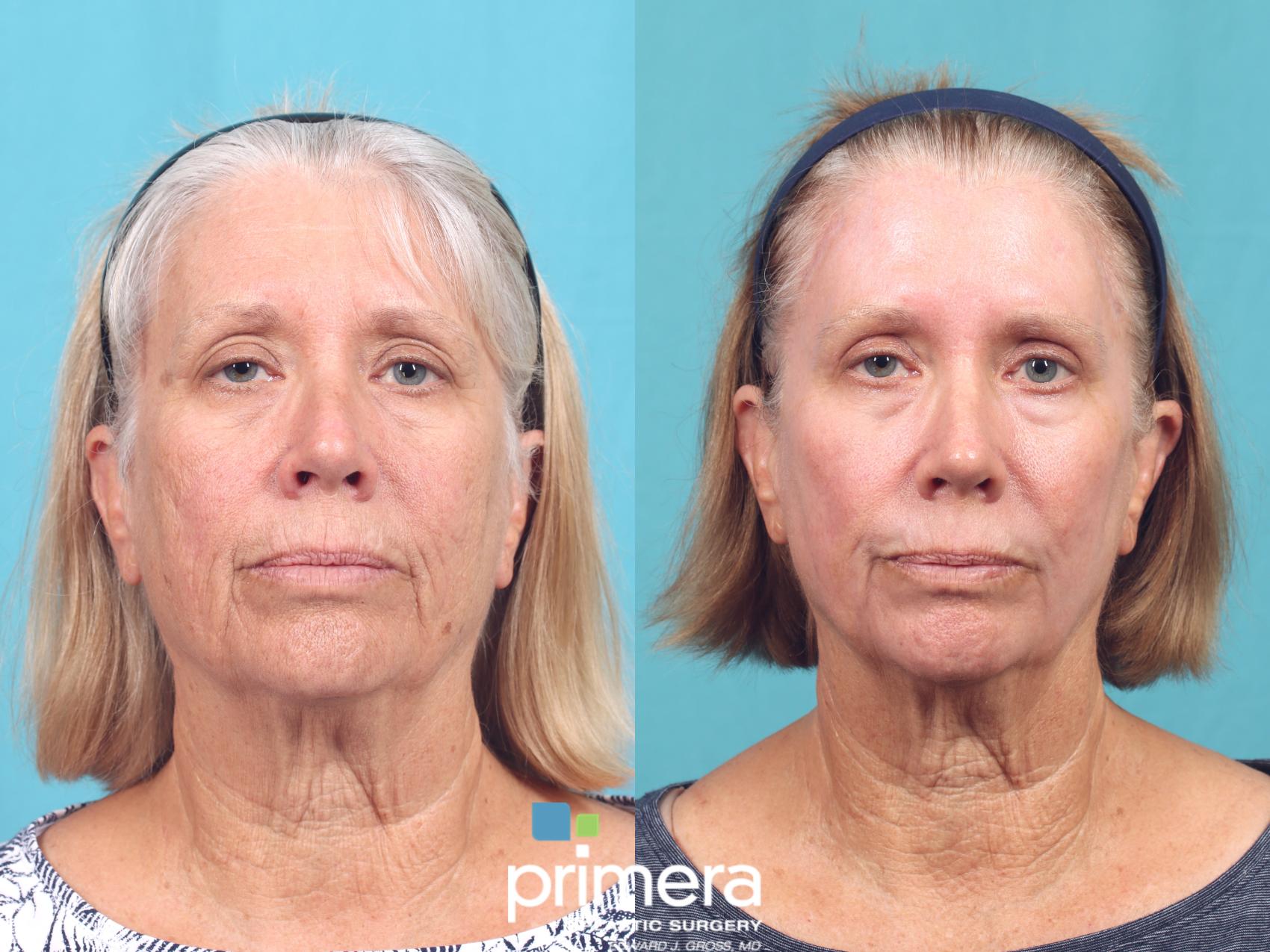 Before & After Brow Lift Case 1008 Front View in Orlando, Winter Park & Tampa, Florida