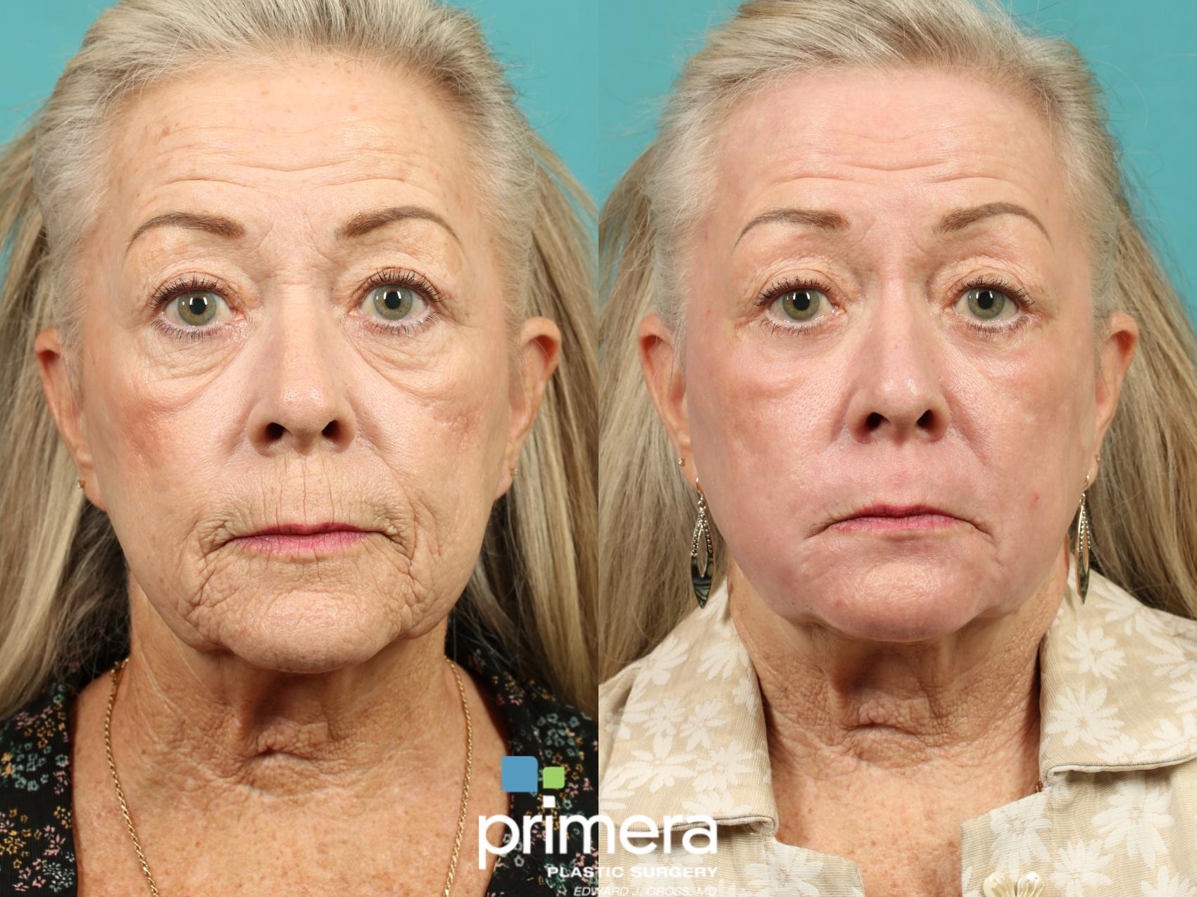 Before & After Chemical Peel Case 970 Front View in Orlando, Florida