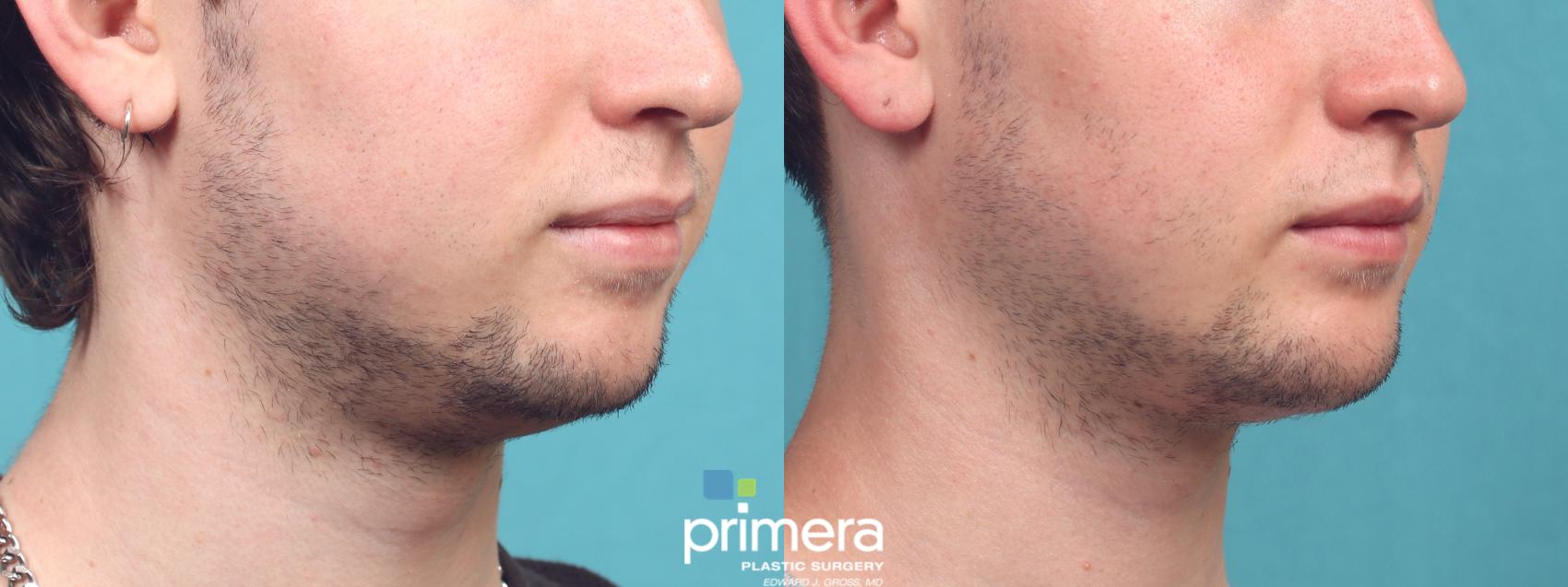 Before & After Chin & Cheek Implant Case 1032 Right Oblique View in Orlando, Winter Park & Tampa, Florida