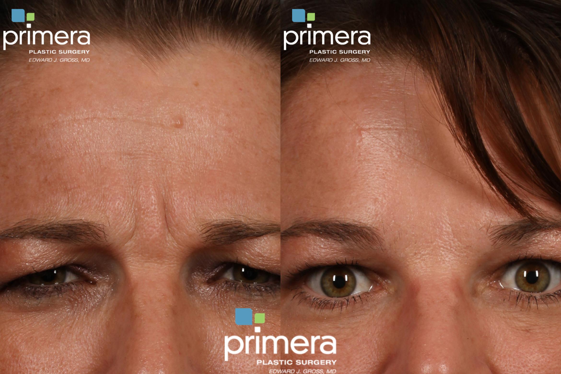 Dysport® Before & After Photo | Orlando, Florida | Primera Plastic Surgery