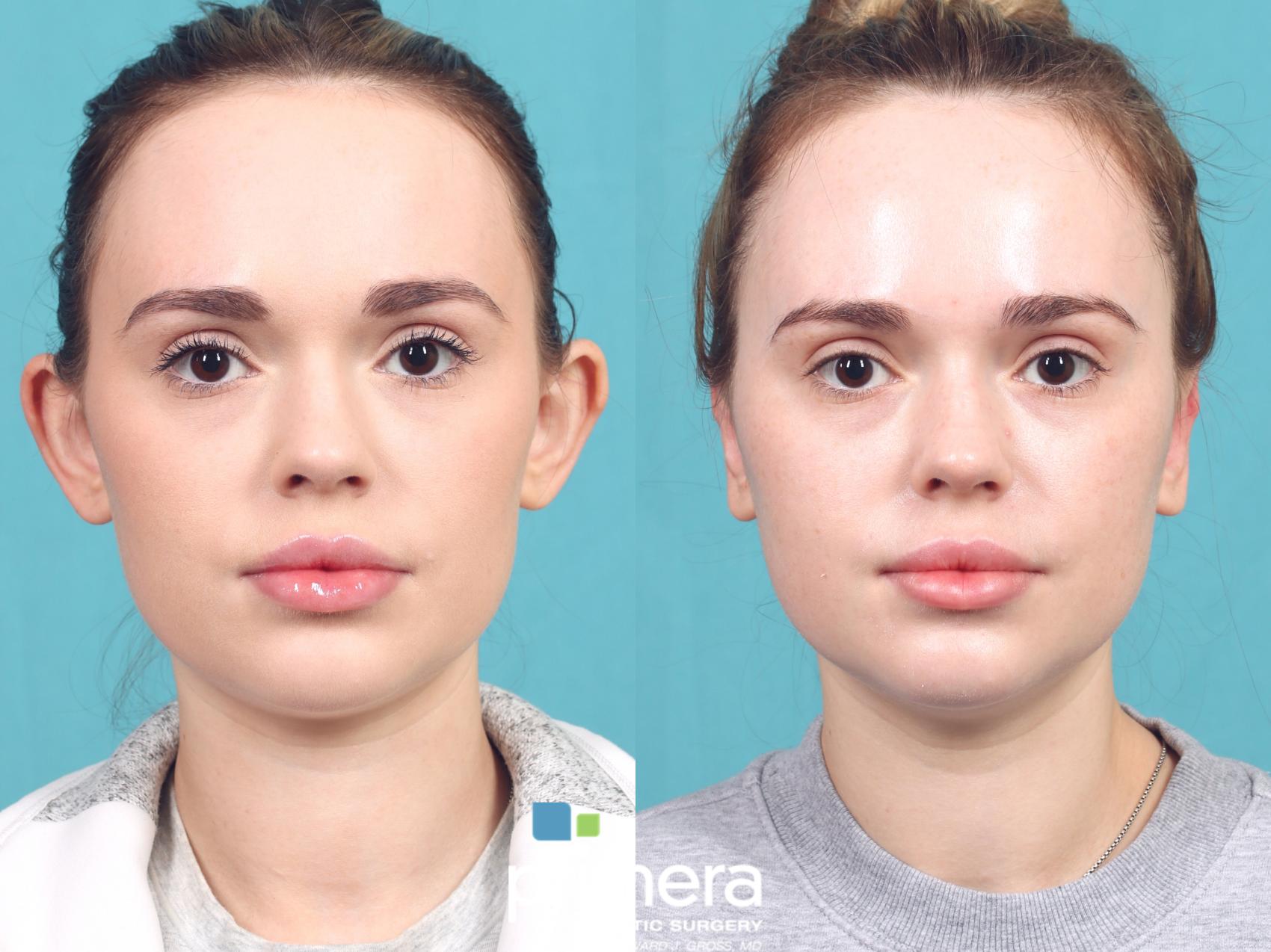 Before & After Ear Surgery (Otoplasty) Case 1029 Left Side View in Orlando, Winter Park & Tampa, Florida