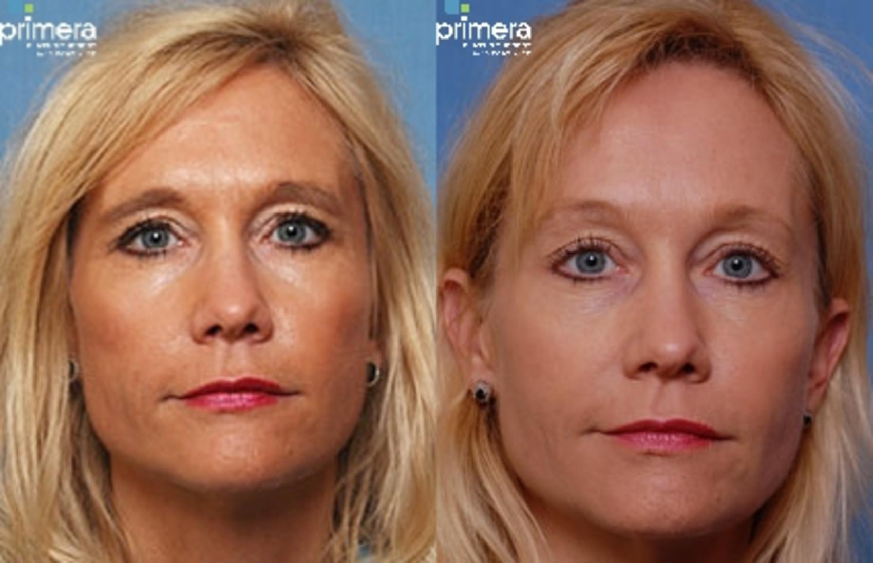 Before & After Endoscopic Forehead Lift Case 27 view-1 View in Orlando, Florida