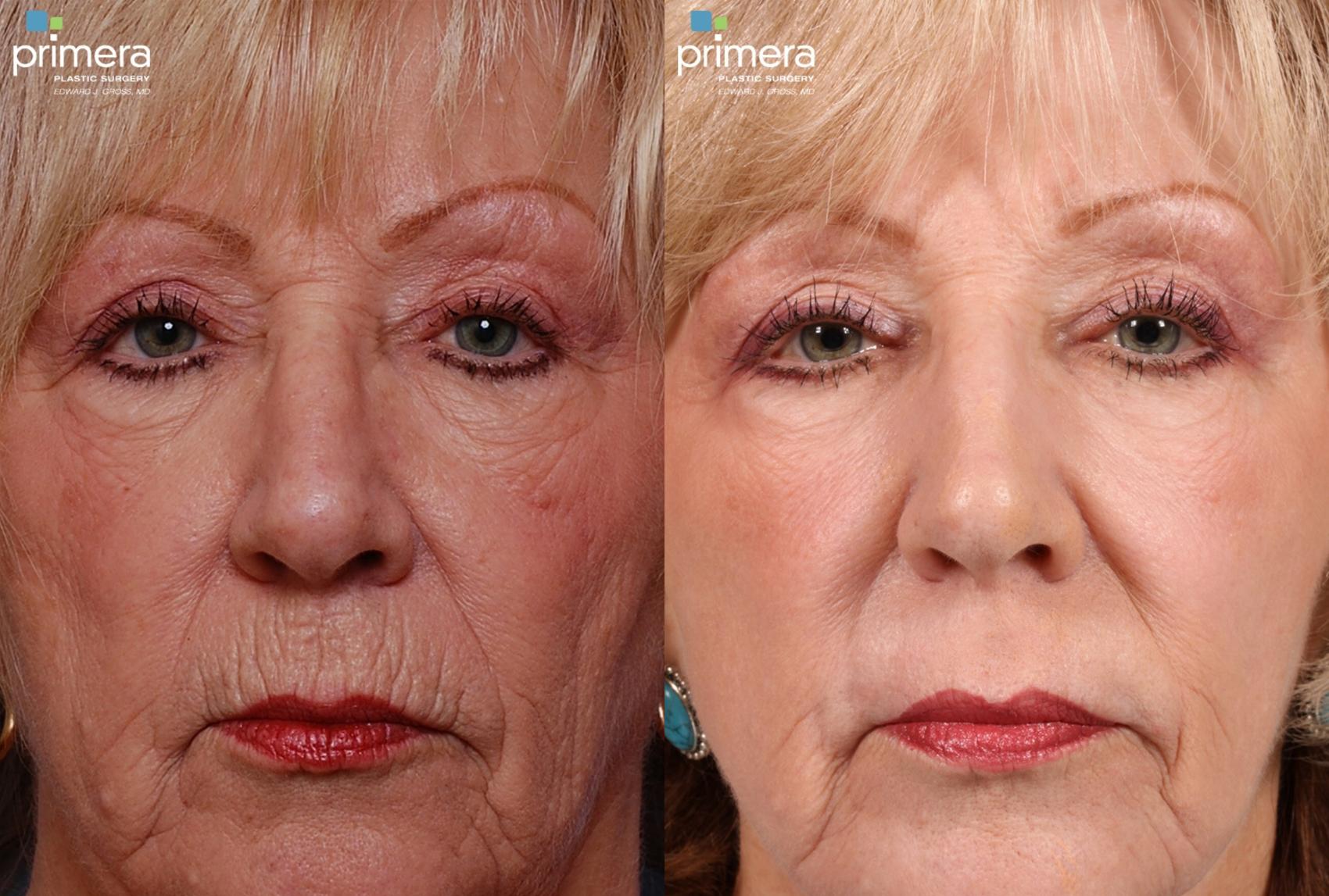 Facelift Before & After Photo | Orlando, Florida | Primera Plastic Surgery