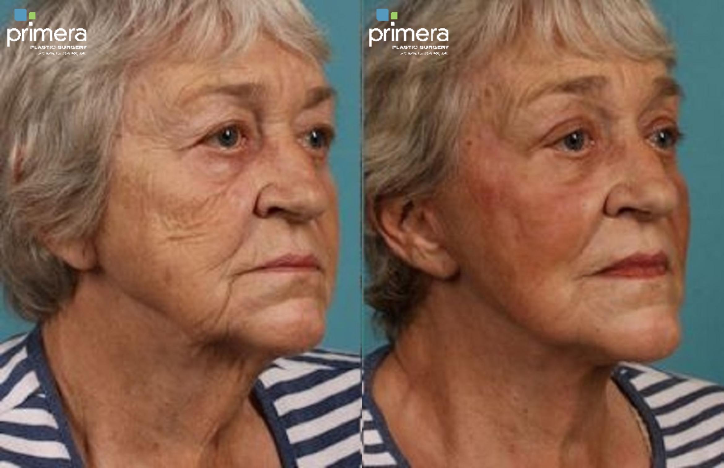 Chemical Peel Before & After Photo | Orlando, Florida | Primera Plastic Surgery
