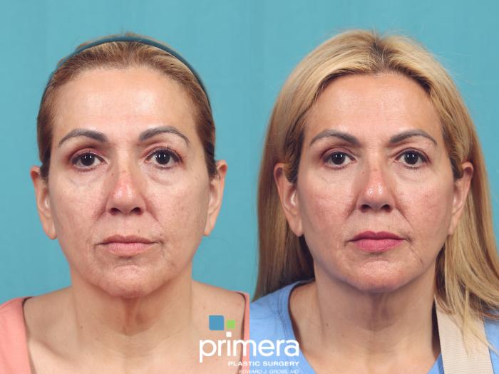 Before & After Injectables Case 1033 Front View in Orlando, Winter Park & Tampa, Florida