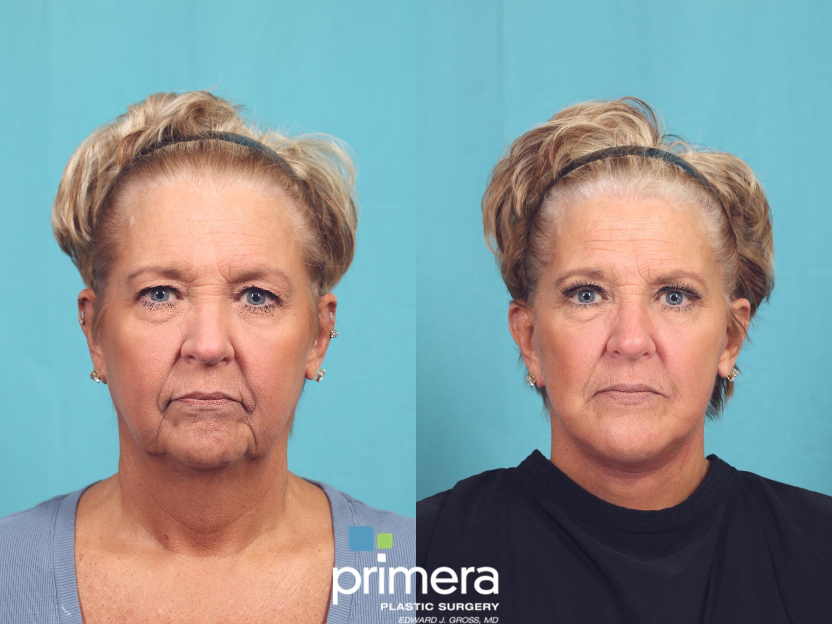 Before & After Mini Facelift Case 1028 Front View in Orlando, Winter Park & Tampa, Florida