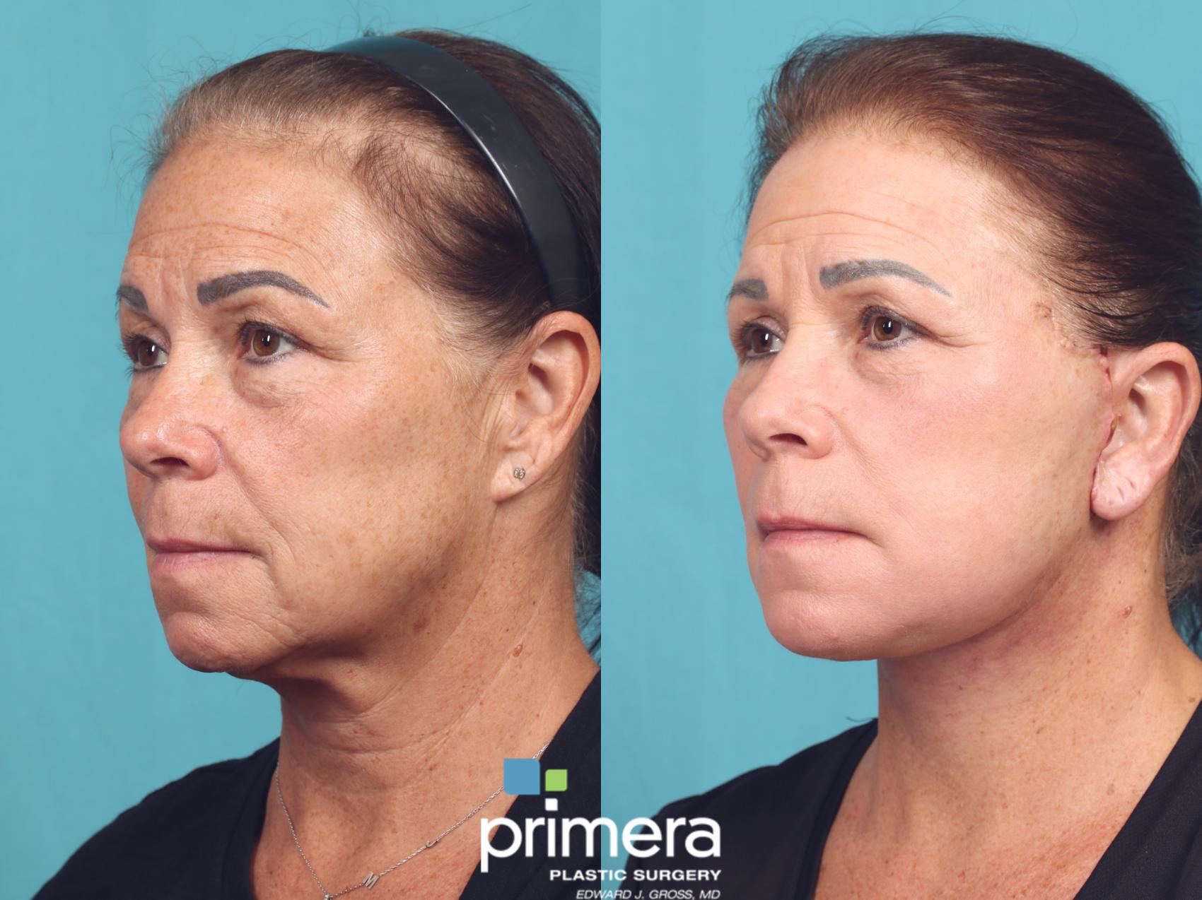 Before & After Laser Skin Resurfacing (DOT CO2) Case 1034 Left Oblique View in Orlando, Winter Park & Tampa, Florida
