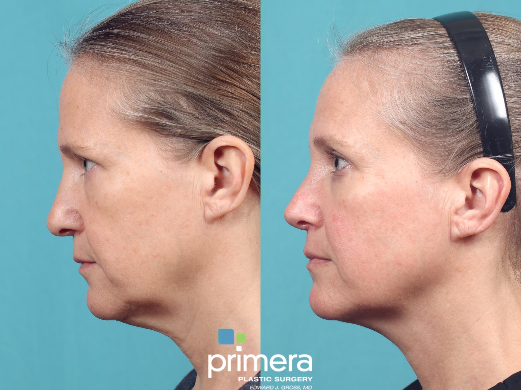 Before & After Revision Rhinoplasty Case 1017 Left Side View in Orlando, Winter Park & Tampa, Florida