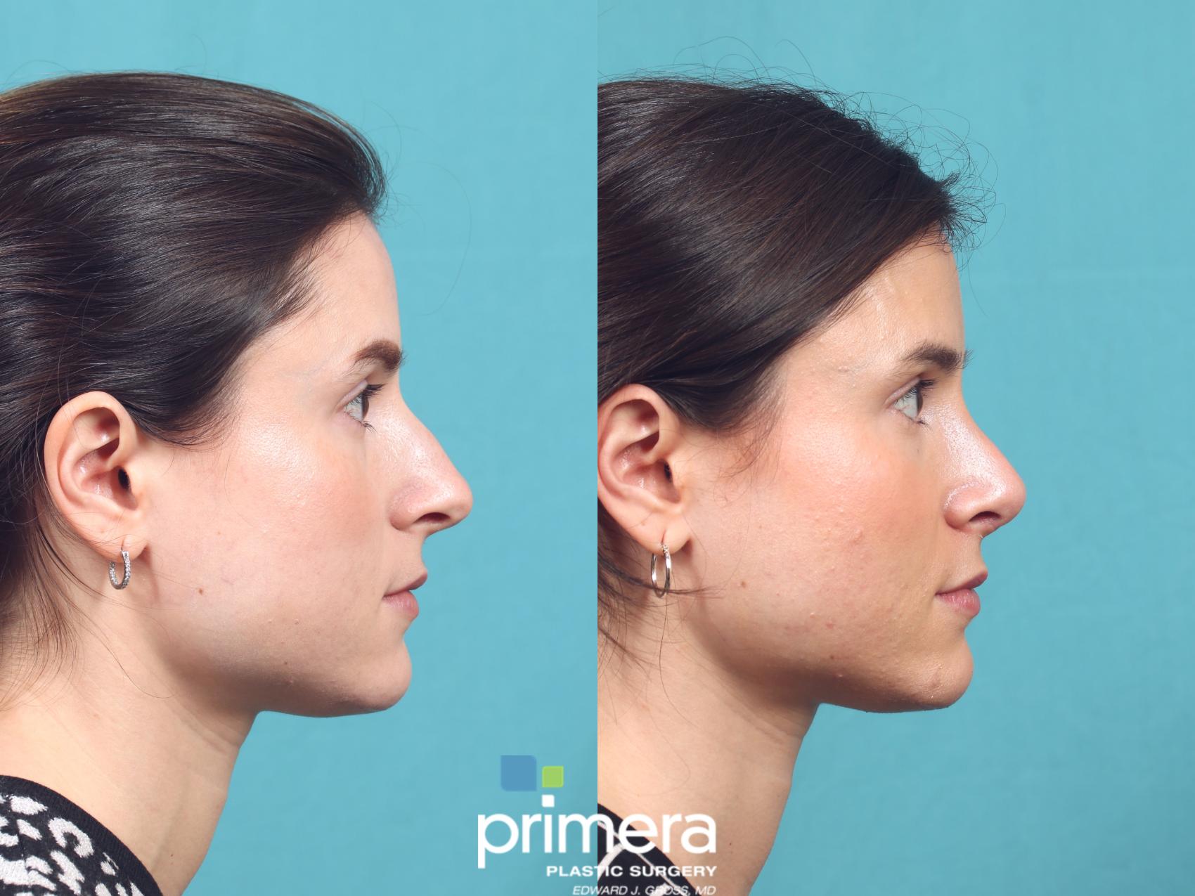 Before & After Rhinoplasty Case 1003 Left Side View in Orlando, Winter Park & Tampa, Florida