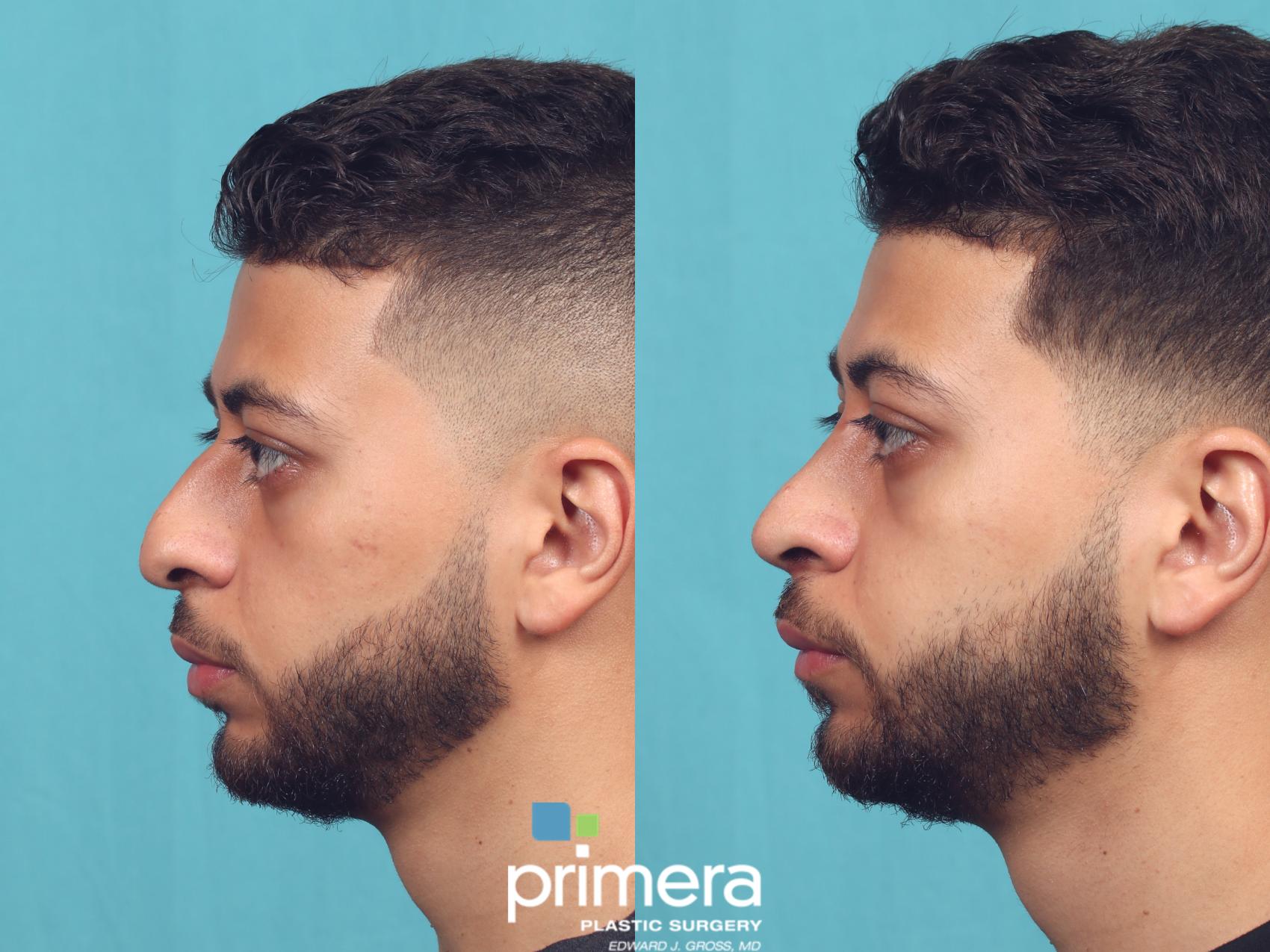 Before & After Rhinoplasty Case 1007 Left Side View in Orlando, Winter Park & Tampa, Florida