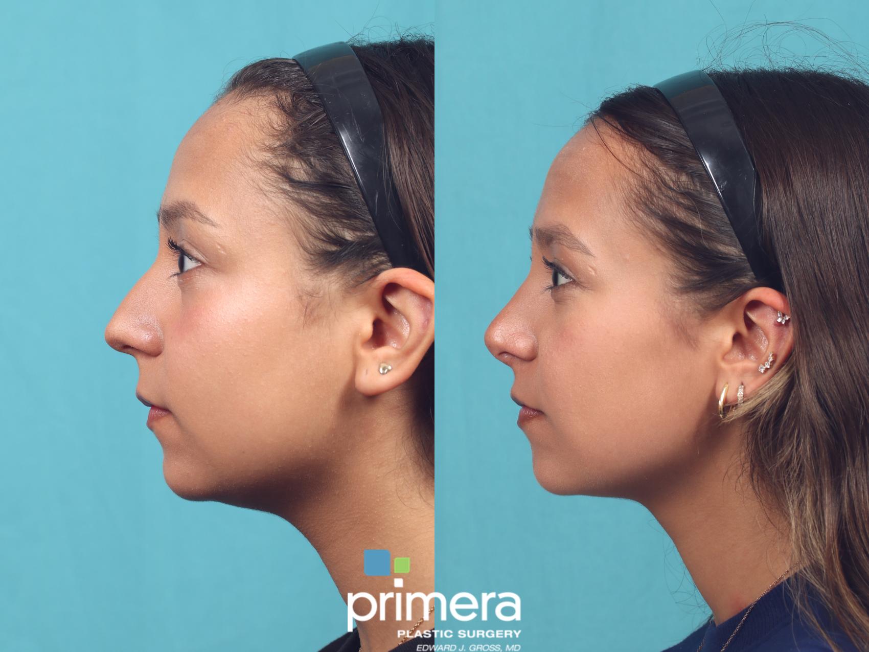 Before & After Rhinoplasty Case 1010 Left Side View in Orlando, Winter Park & Tampa, Florida