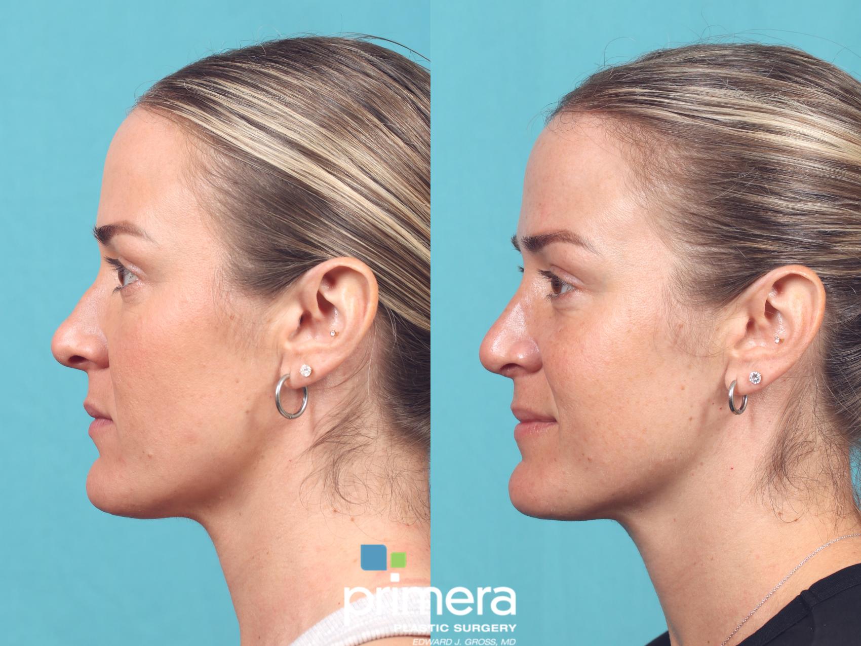 Before & After Rhinoplasty Case 1014 Left Side View in Orlando, Winter Park & Tampa, Florida