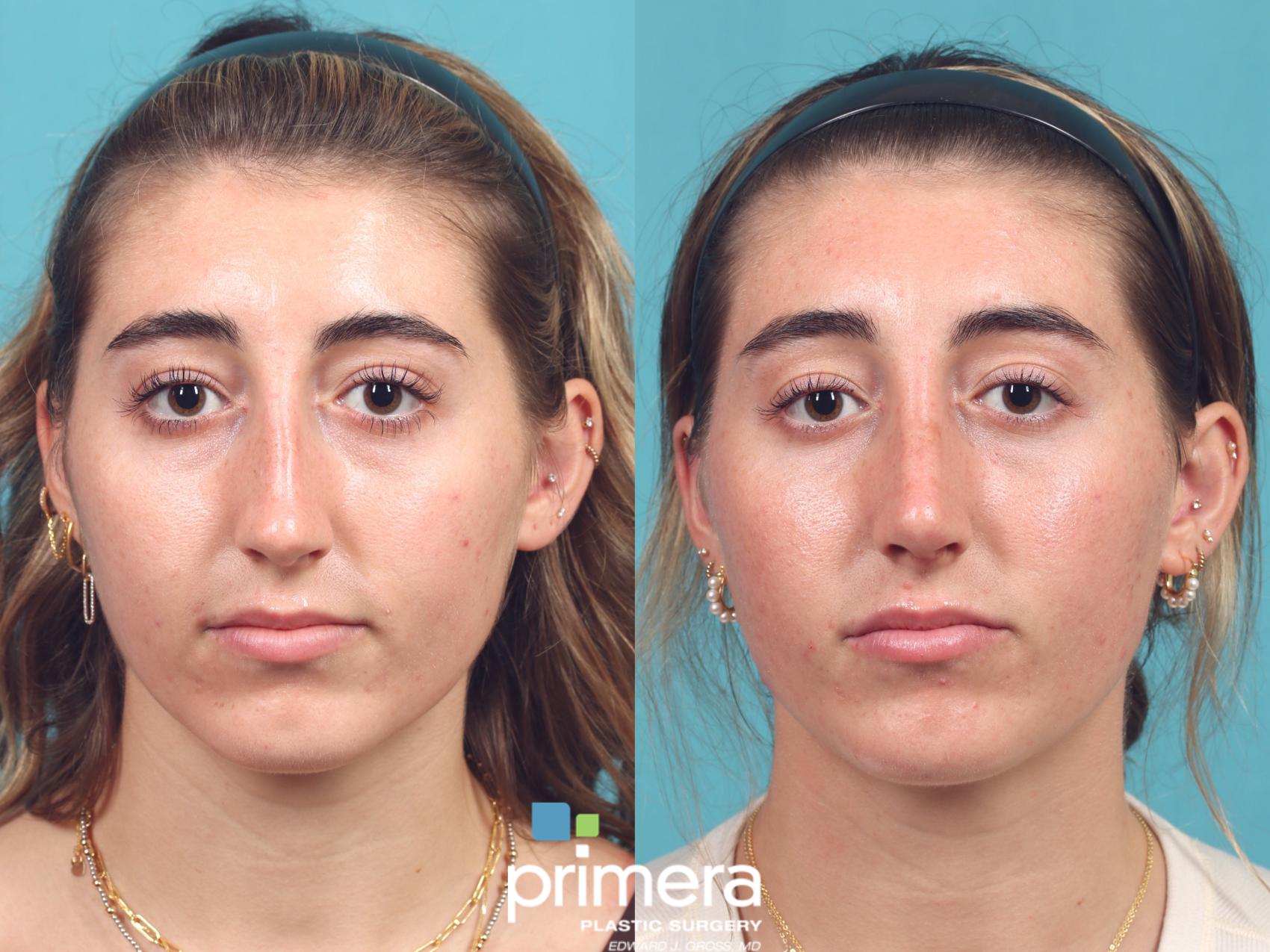 Before & After Rhinoplasty Case 1020 Front View in Orlando, Winter Park & Tampa, Florida
