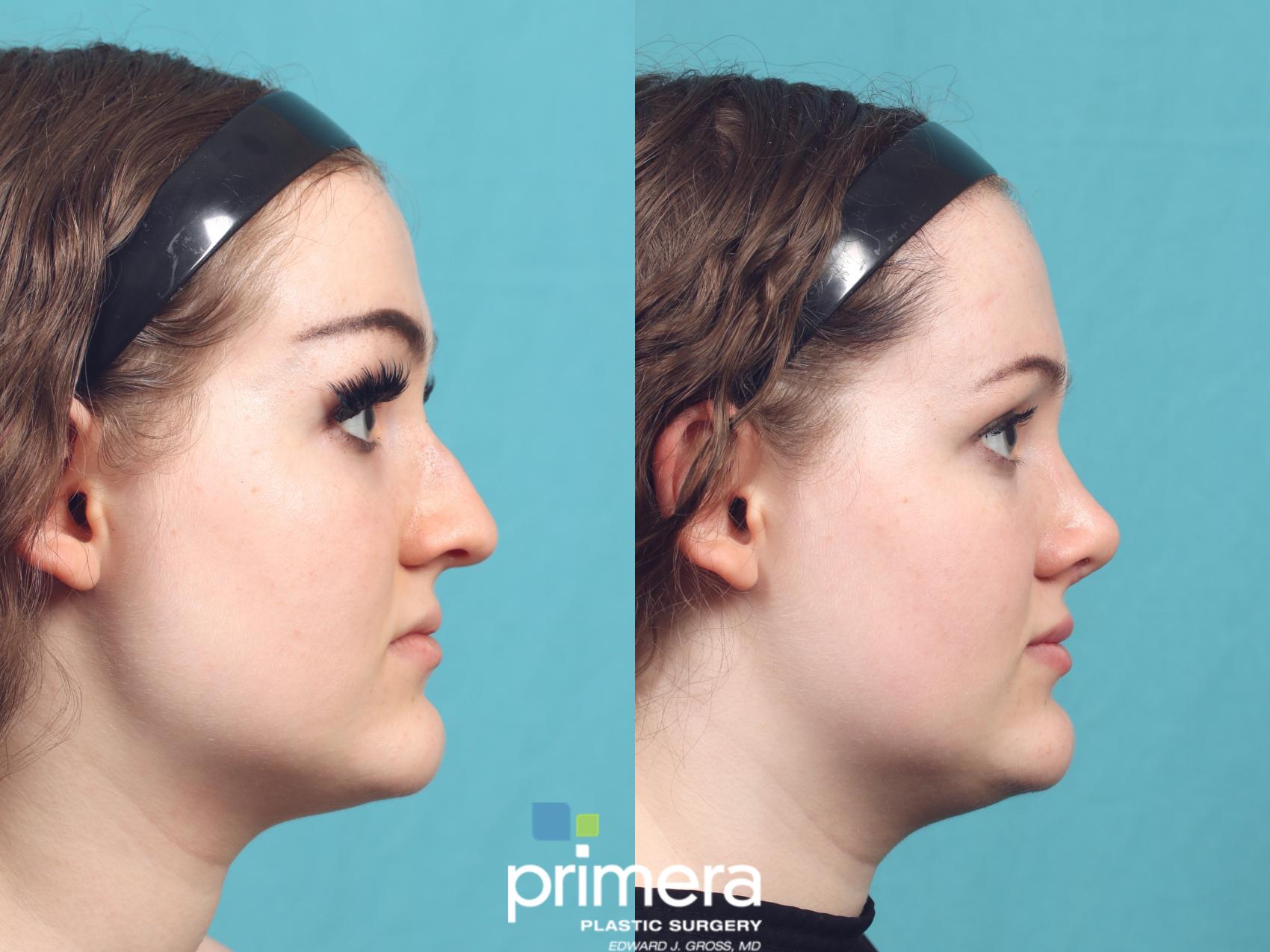 Before & After Injectables Case 1030 Right Side View in Orlando, Winter Park & Tampa, Florida