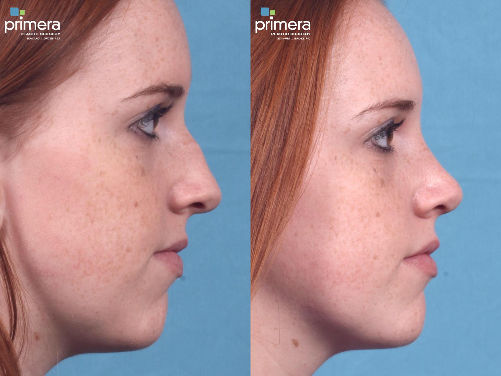 Rhinoplasty Before & After Photo | Orlando, Florida | Primera Plastic Surgery