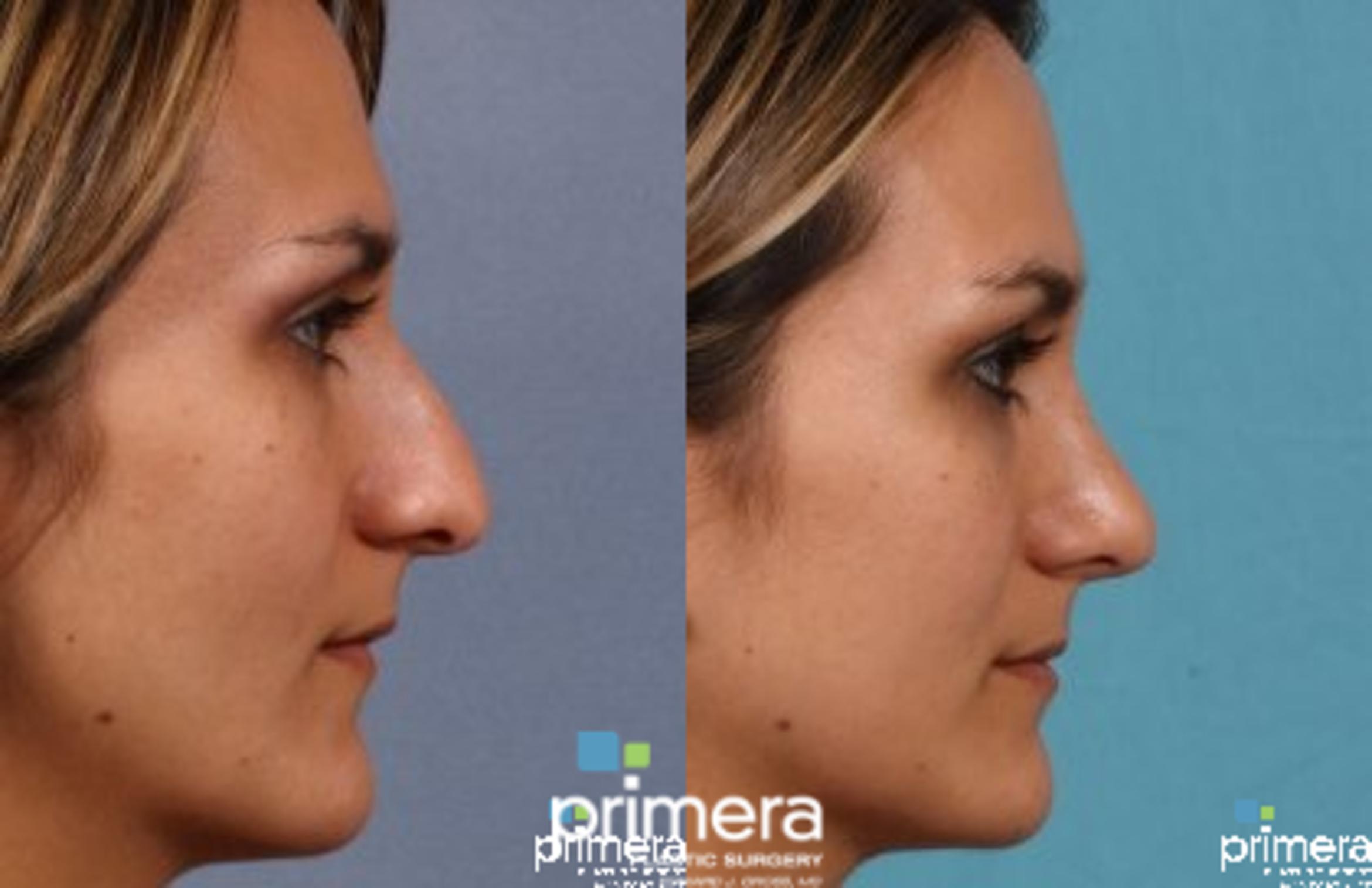 Rhinoplasty Before & After Photo | Orlando, Florida | Primera Plastic Surgery