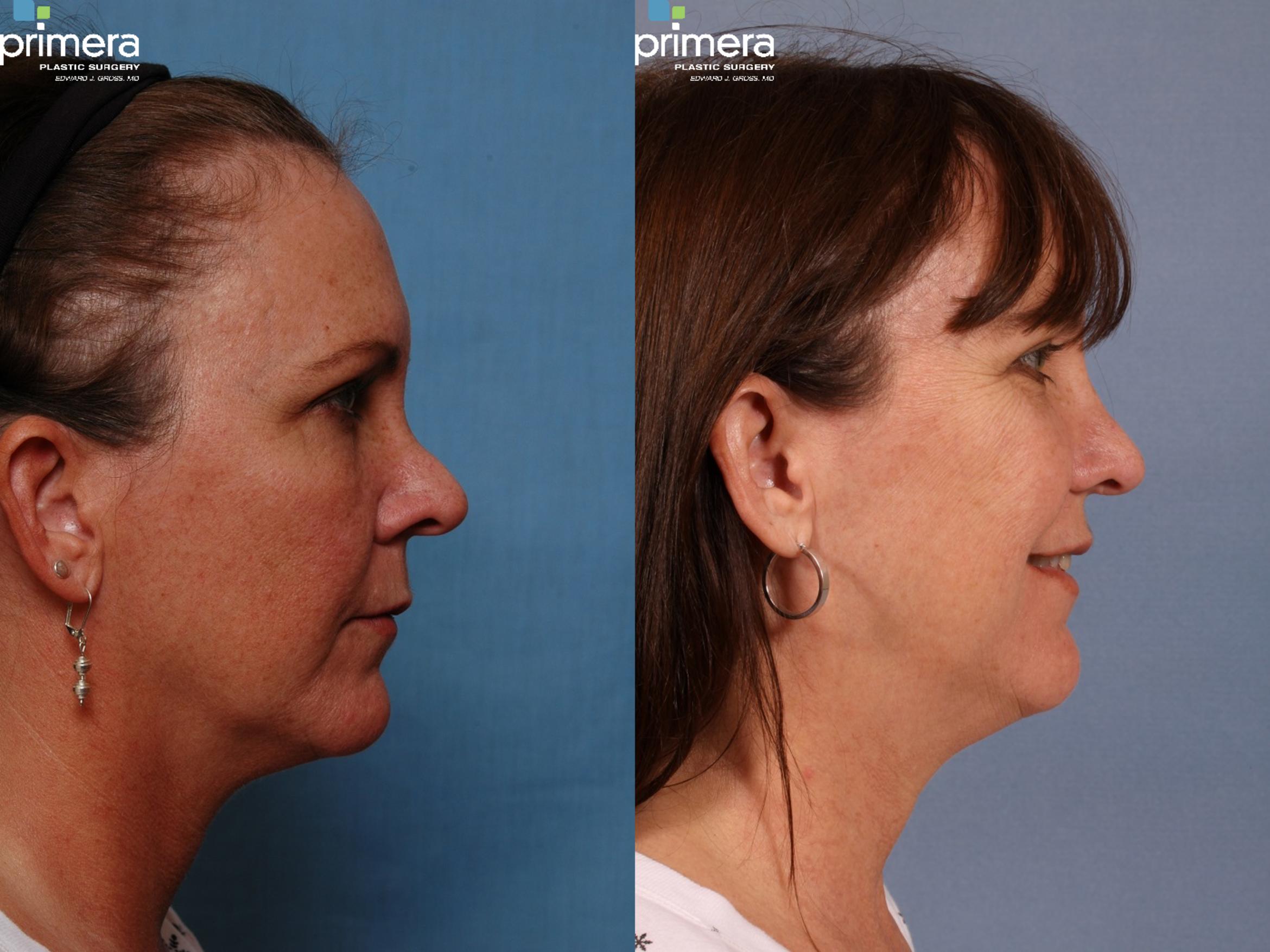 Rhinoplasty Before & After Photo | Orlando, Florida | Primera Plastic Surgery