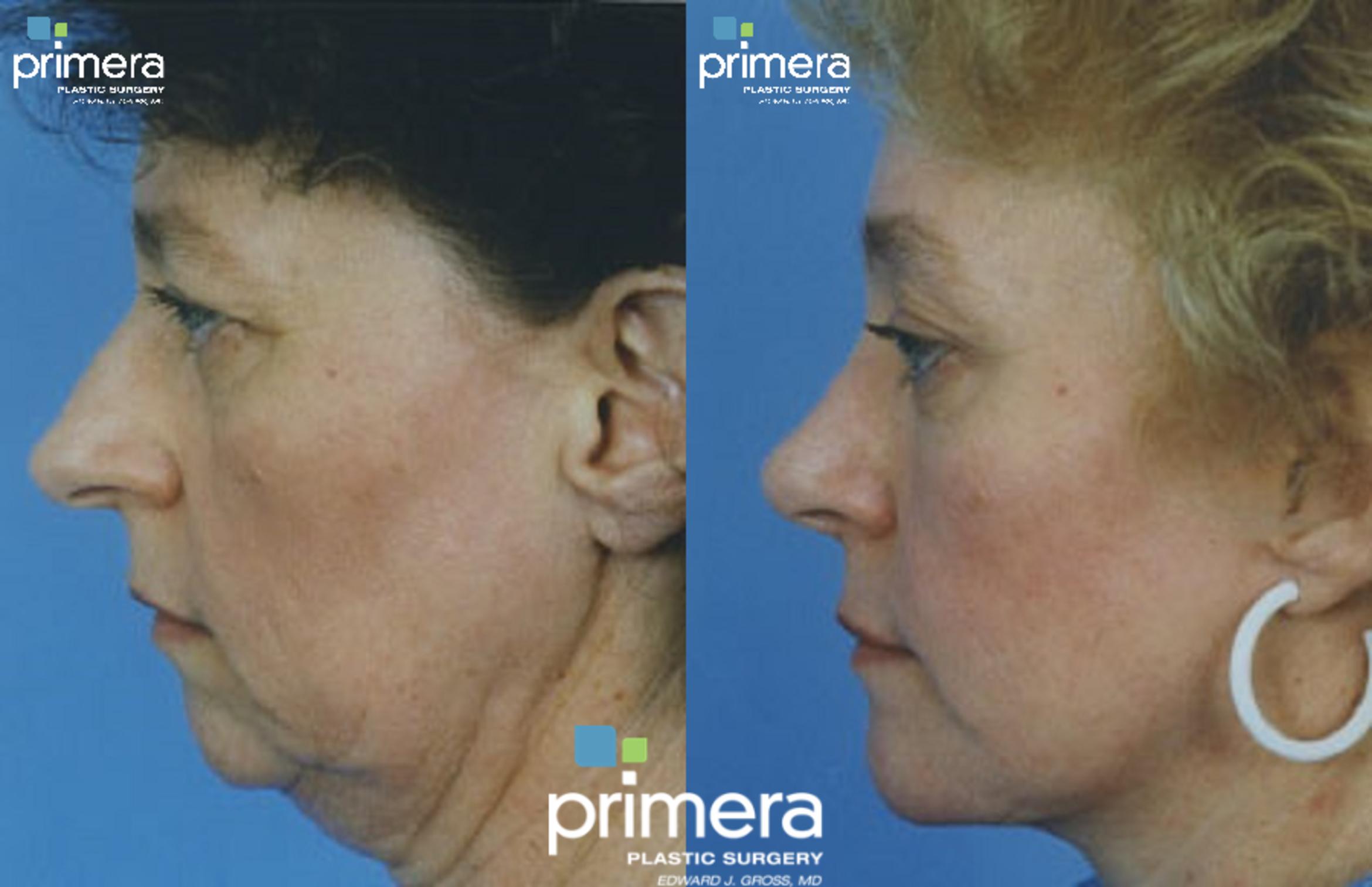 Rhinoplasty Before & After Photo | Orlando, Florida | Primera Plastic Surgery