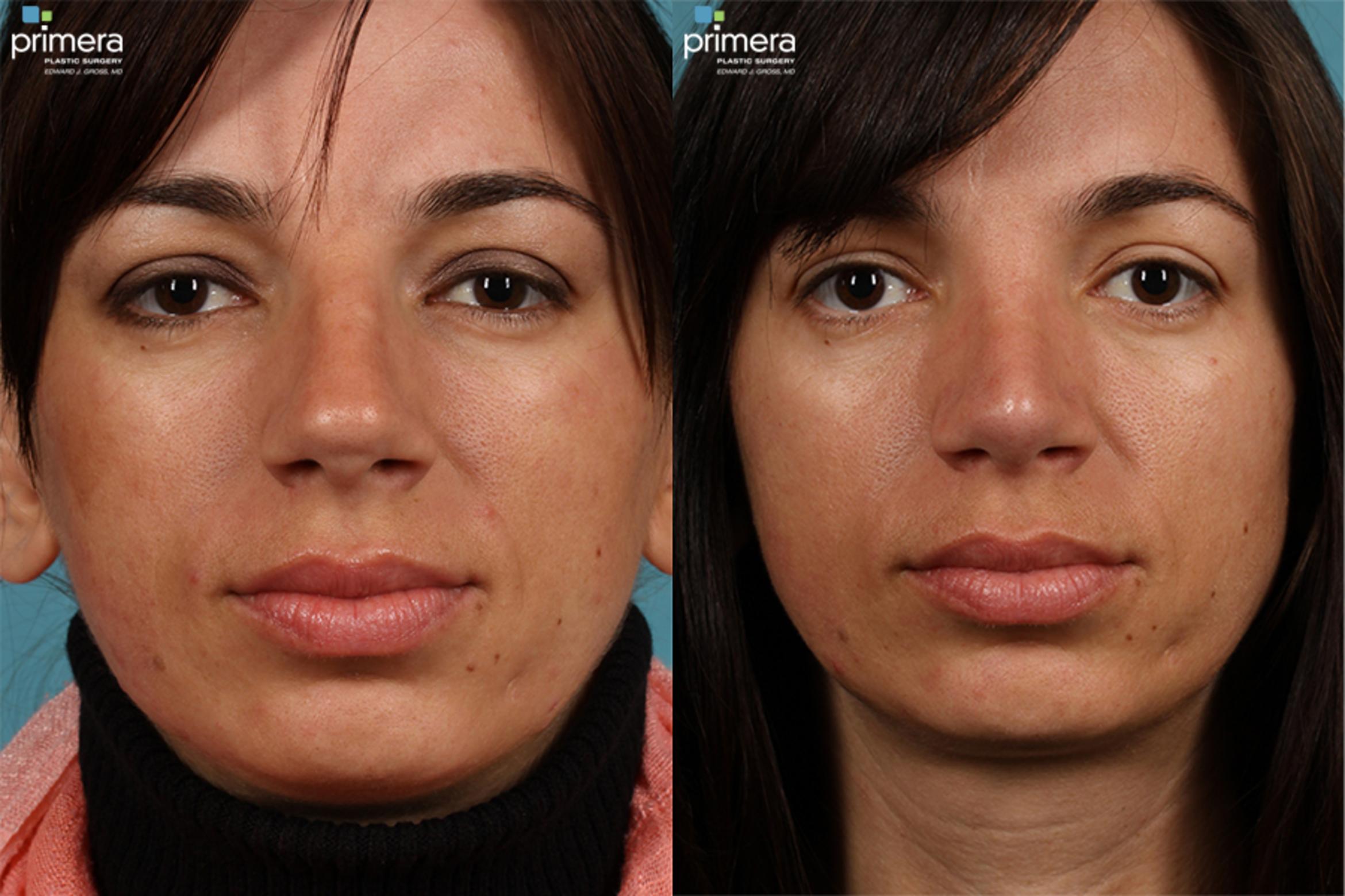 Rhinoplasty Before & After Photo | Orlando, Florida | Primera Plastic Surgery