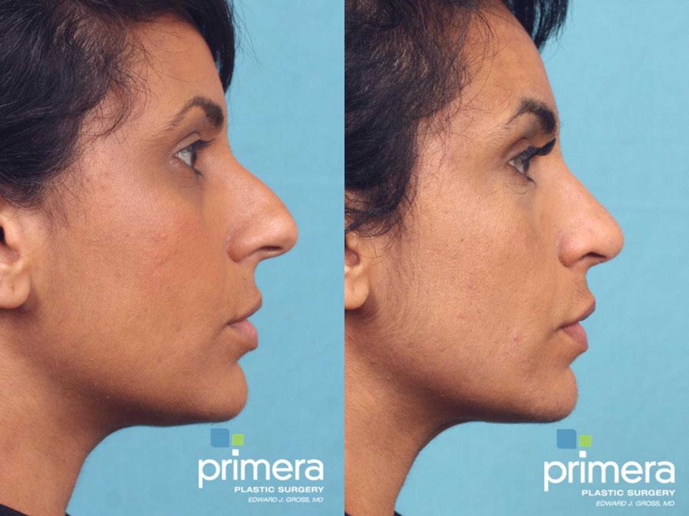 Rhinoplasty Before & After Photo | Orlando, Florida | Primera Plastic Surgery