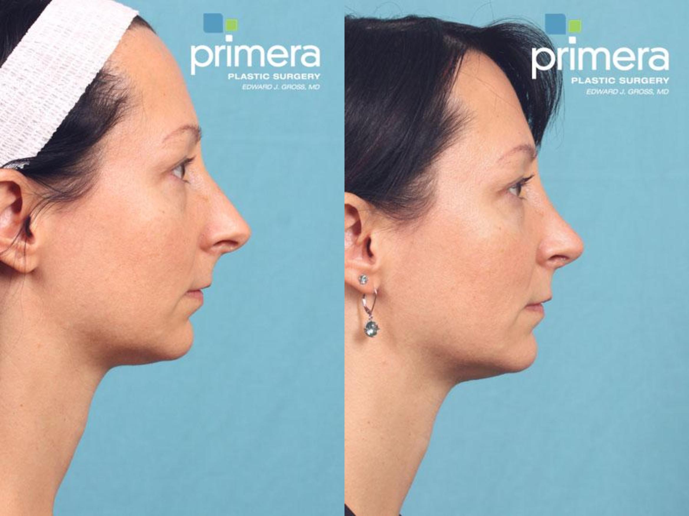 Rhinoplasty Before & After Photo | Orlando, Florida | Primera Plastic Surgery