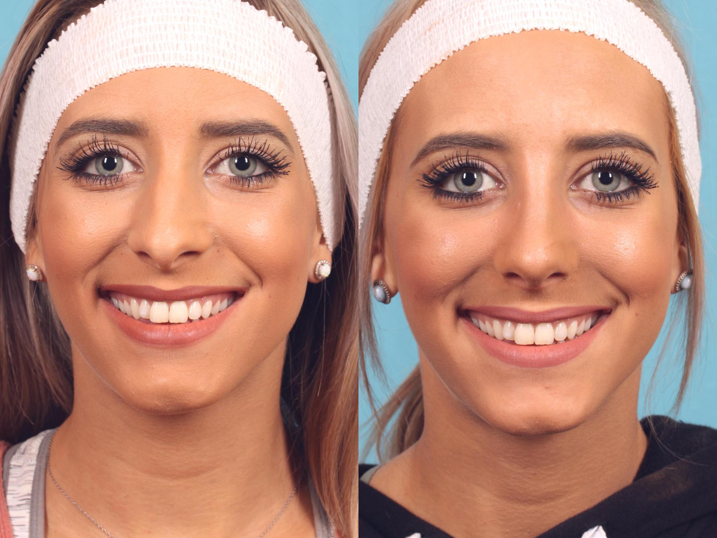Rhinoplasty Before & After Photo | Orlando, Florida | Primera Plastic Surgery