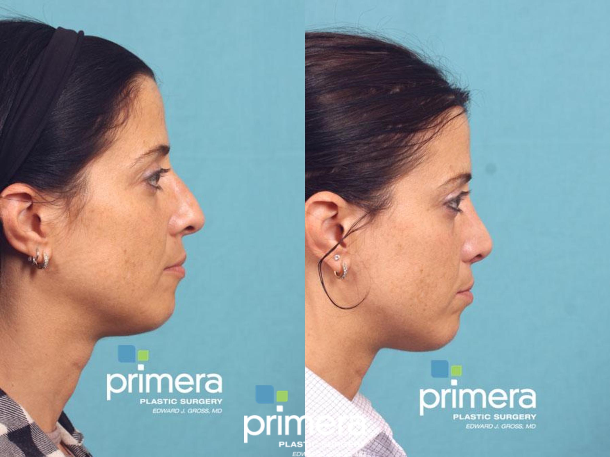 Rhinoplasty Before & After Photo | Orlando, Florida | Primera Plastic Surgery