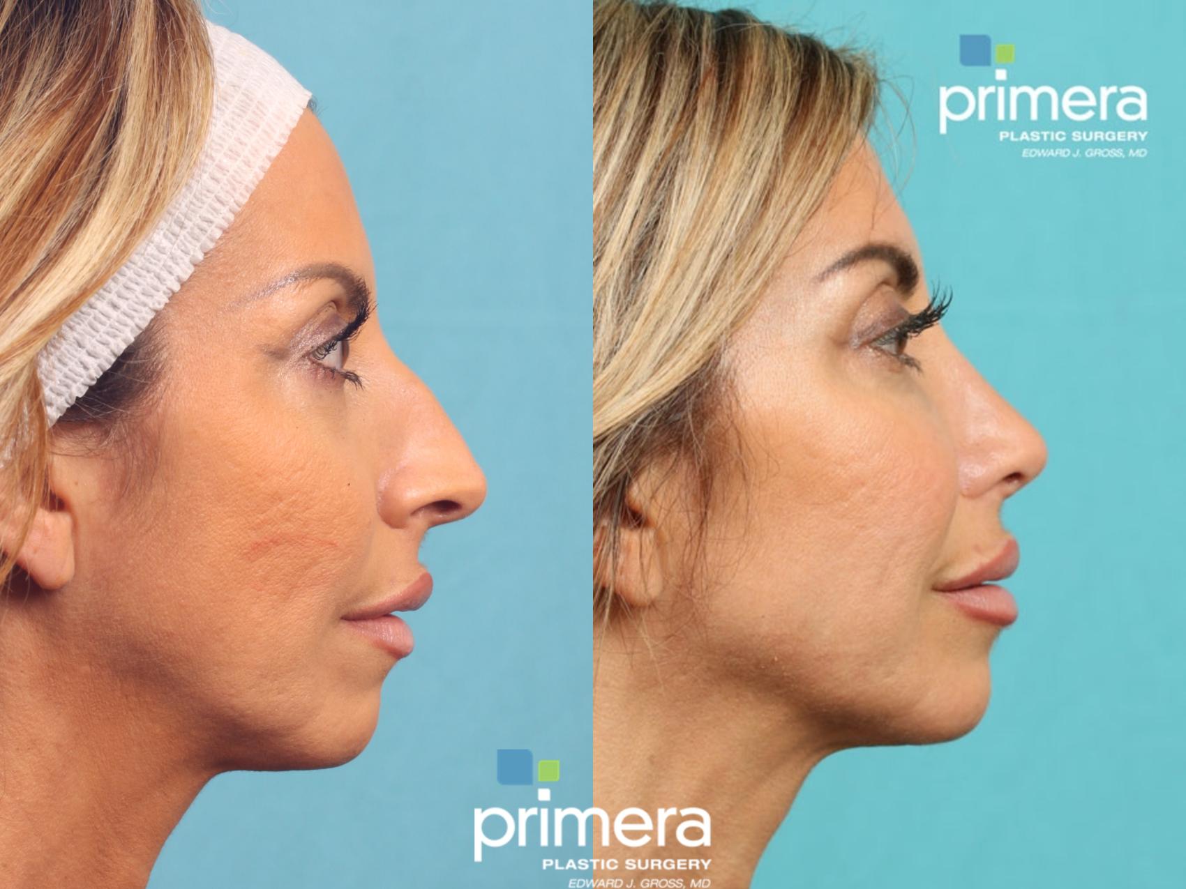 Rhinoplasty Before & After Photo | Orlando, Florida | Primera Plastic Surgery