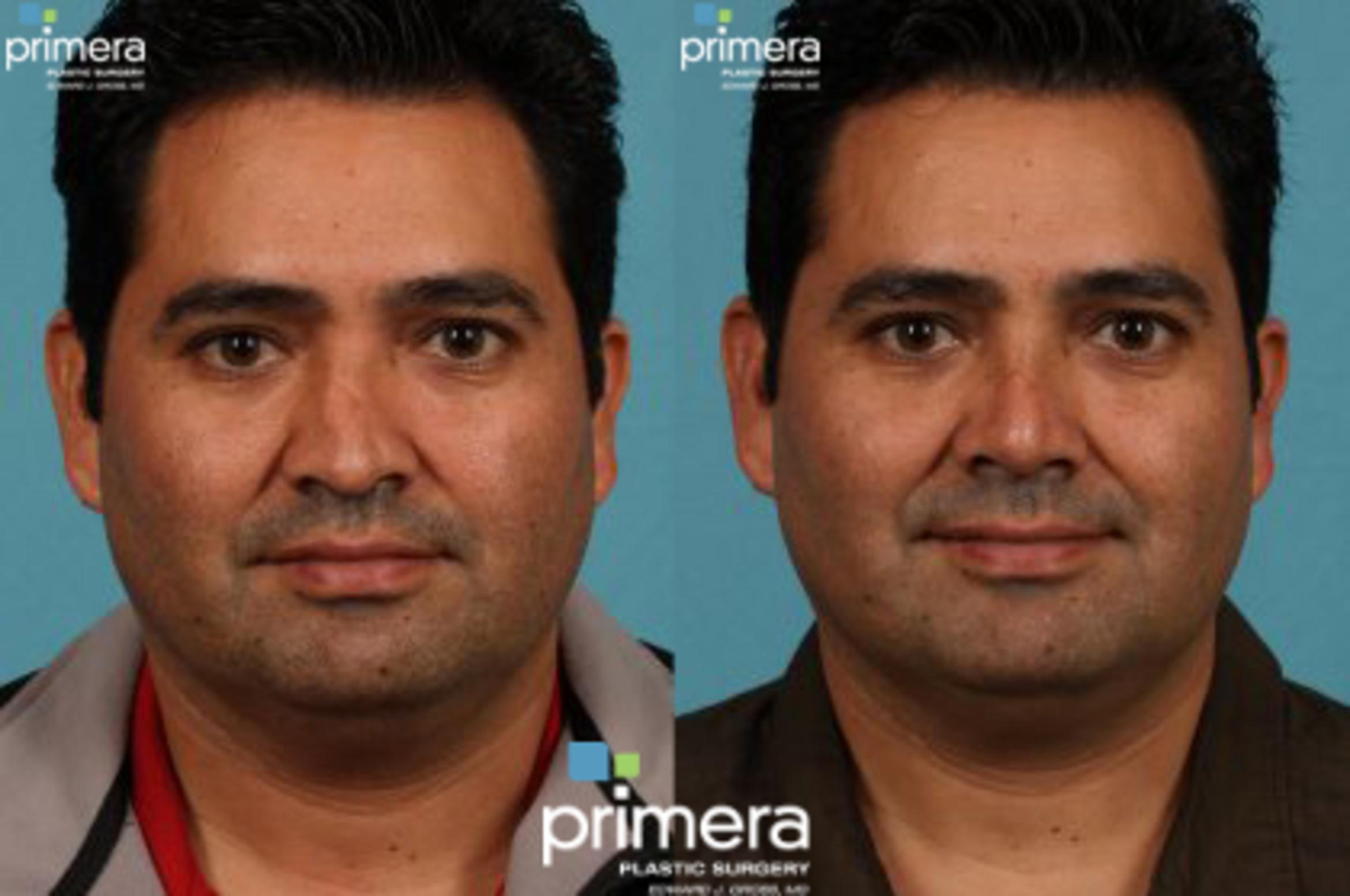 Surgery for Men Before & After Photo | Orlando, Florida | Primera Plastic Surgery