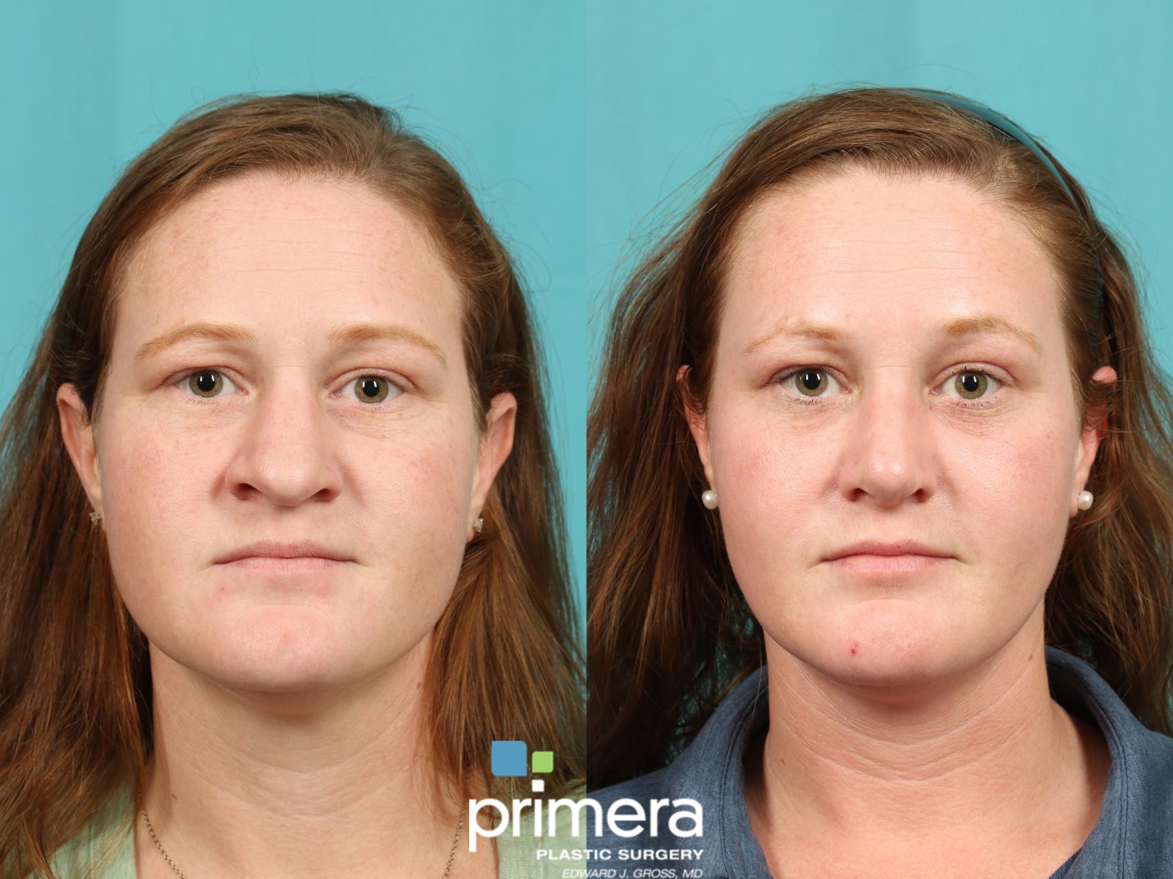 Before & After Rhinoplasty Case 780 Front View in Orlando, Florida