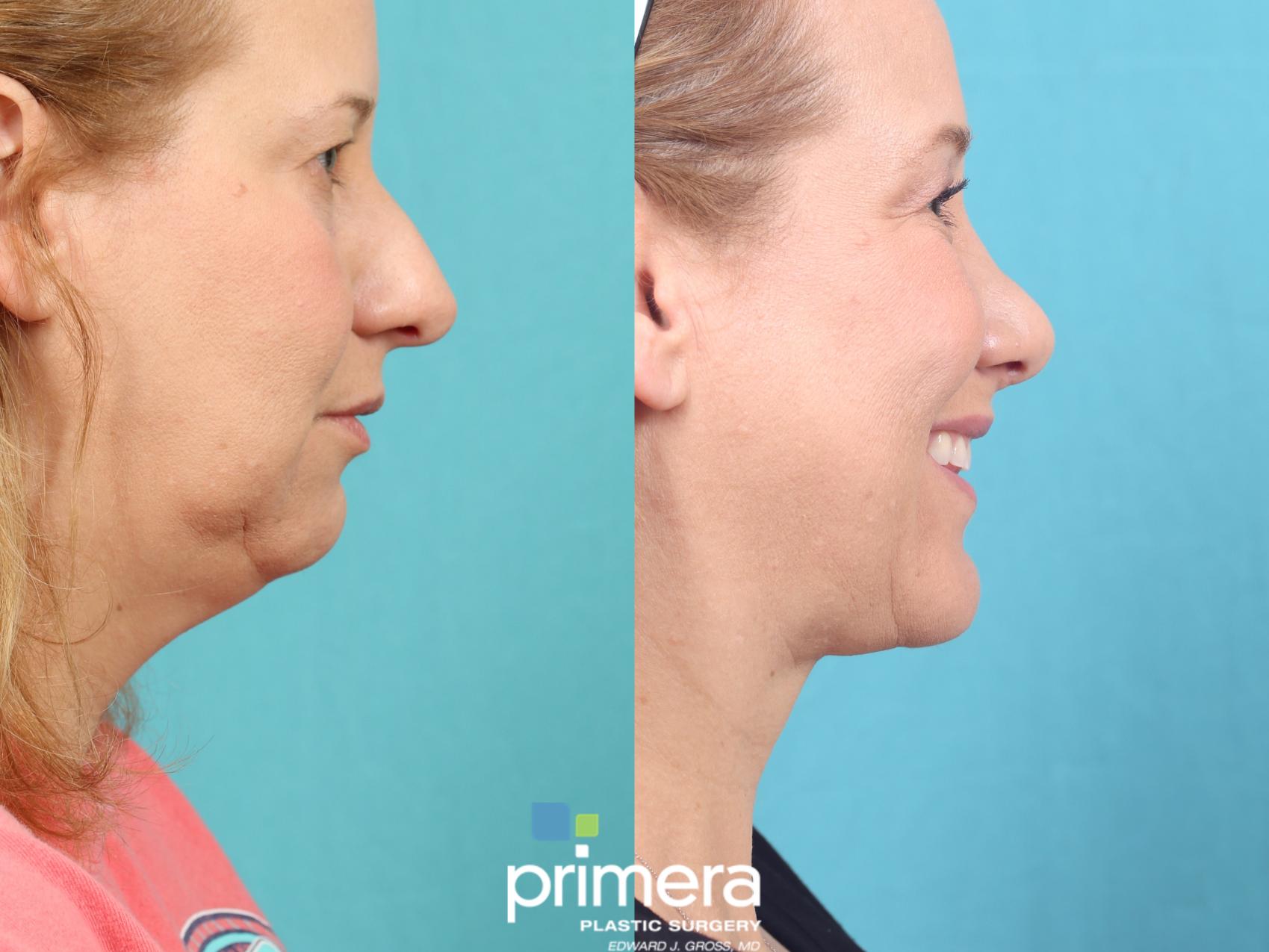 Before & After Submentoplasty (Chin Tuck) Case 794 Right Side View in Orlando, Florida
