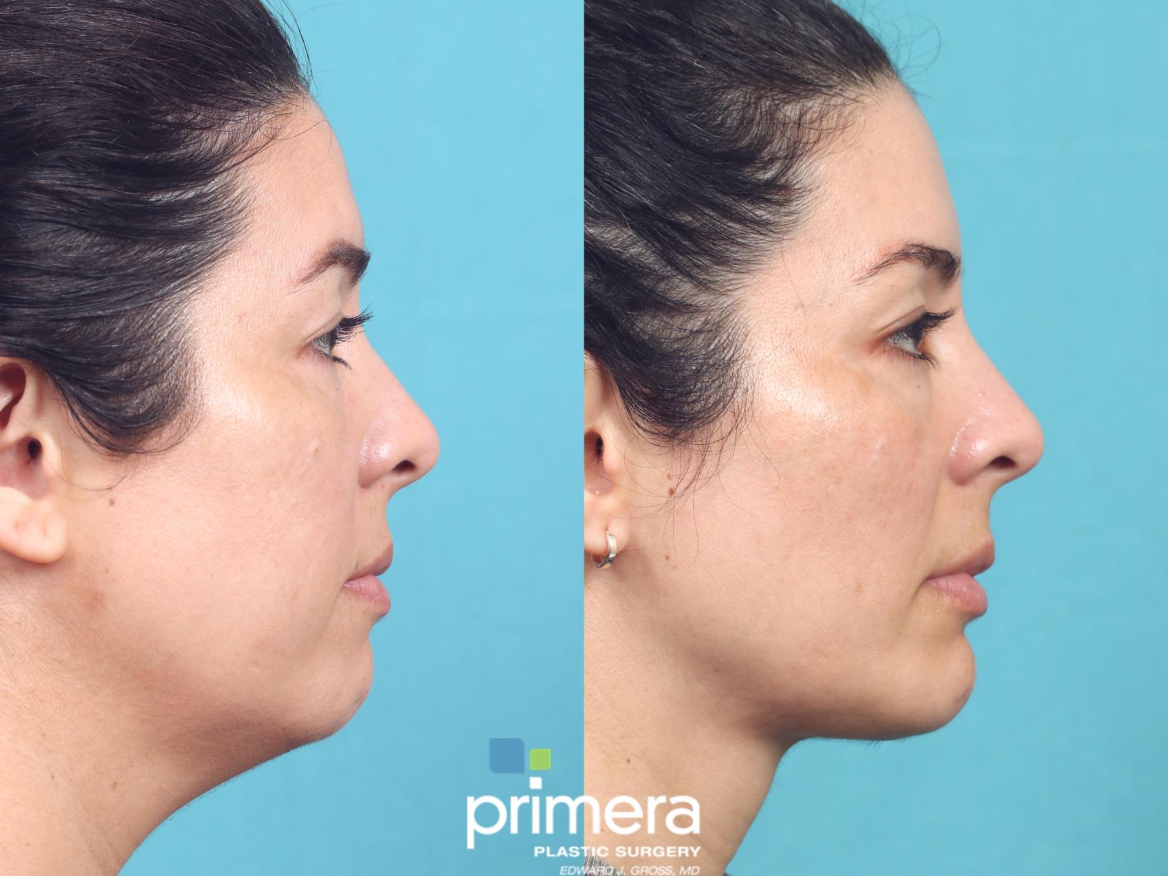 Before & After Submentoplasty (Chin Tuck) Case 849 Right Side View in Orlando, Florida
