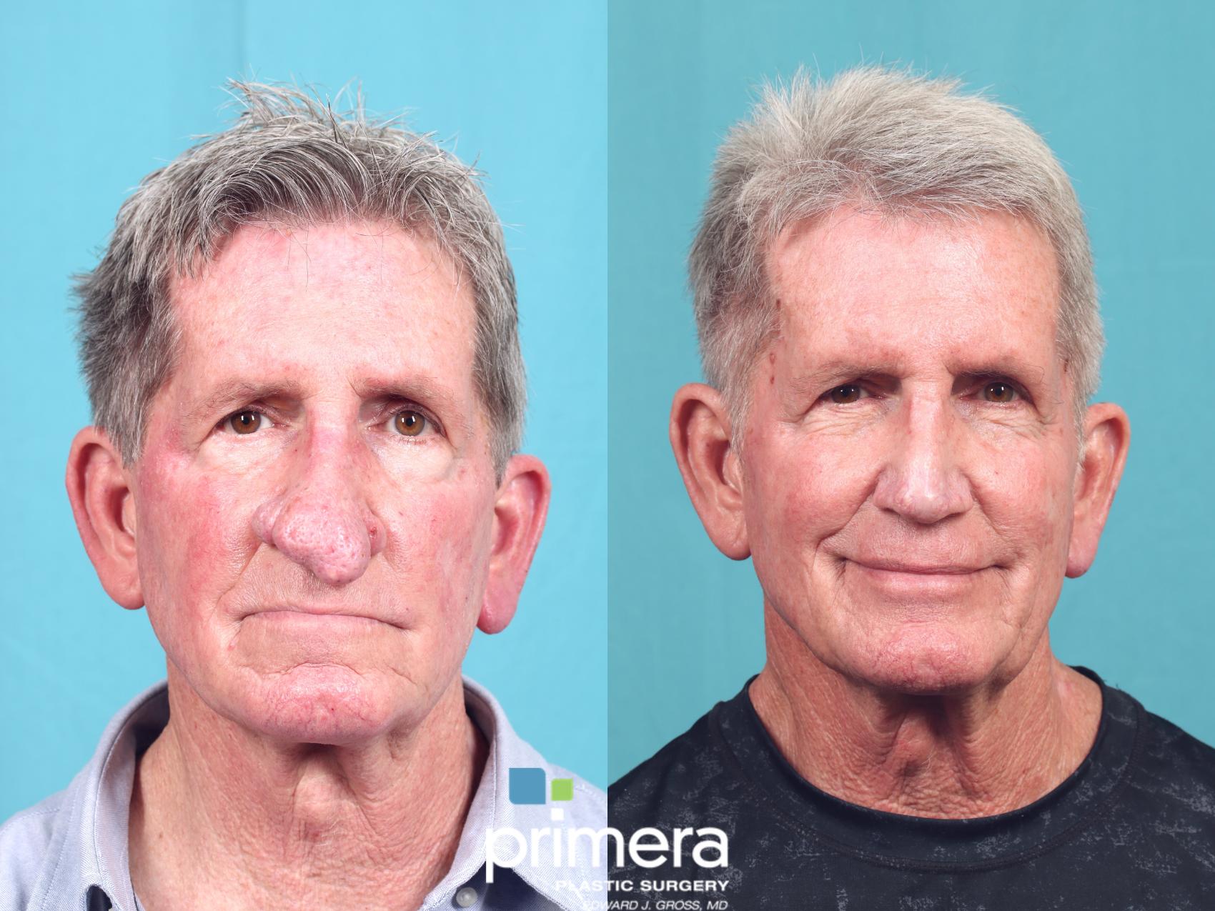 Before & After Surgery for Men Case 1004 Front View in Orlando, Winter Park & Tampa, Florida