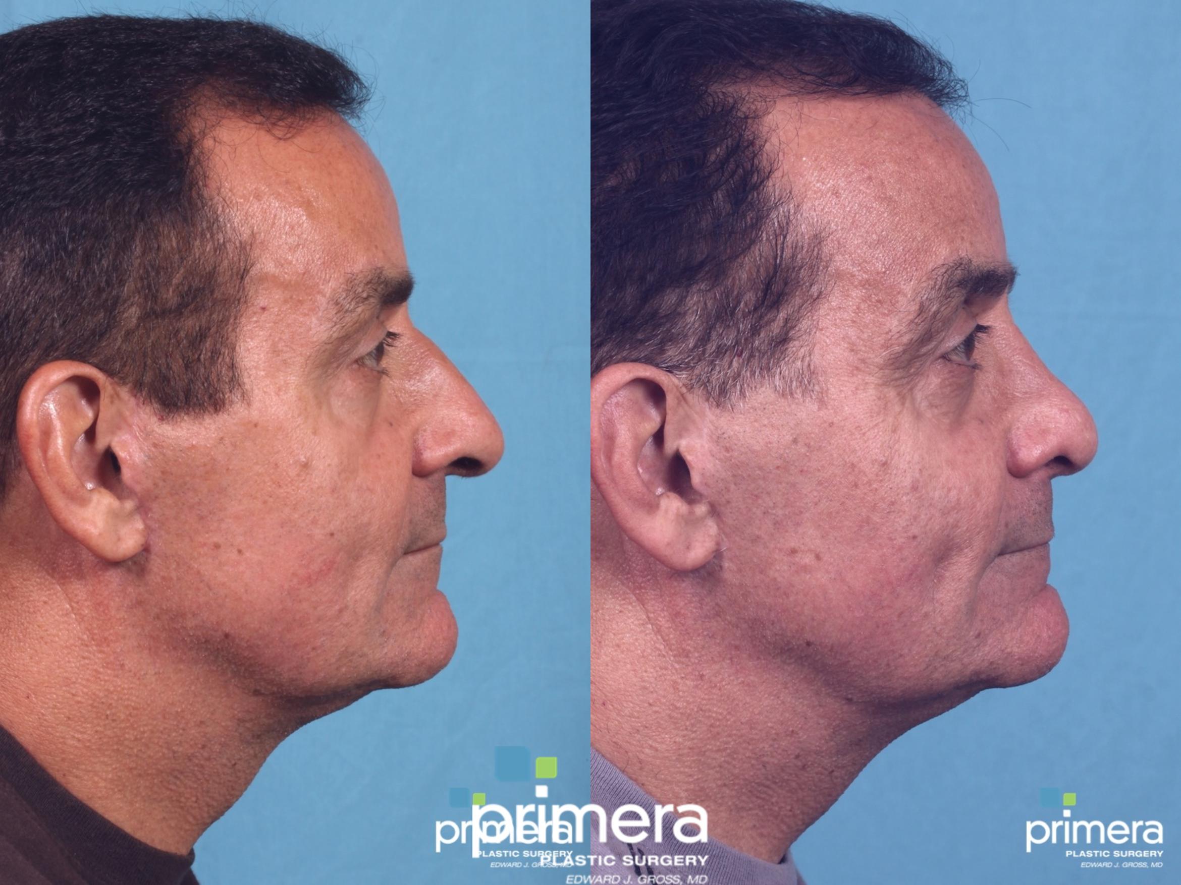 Rhinoplasty Before & After Photo | Orlando, Florida | Primera Plastic Surgery