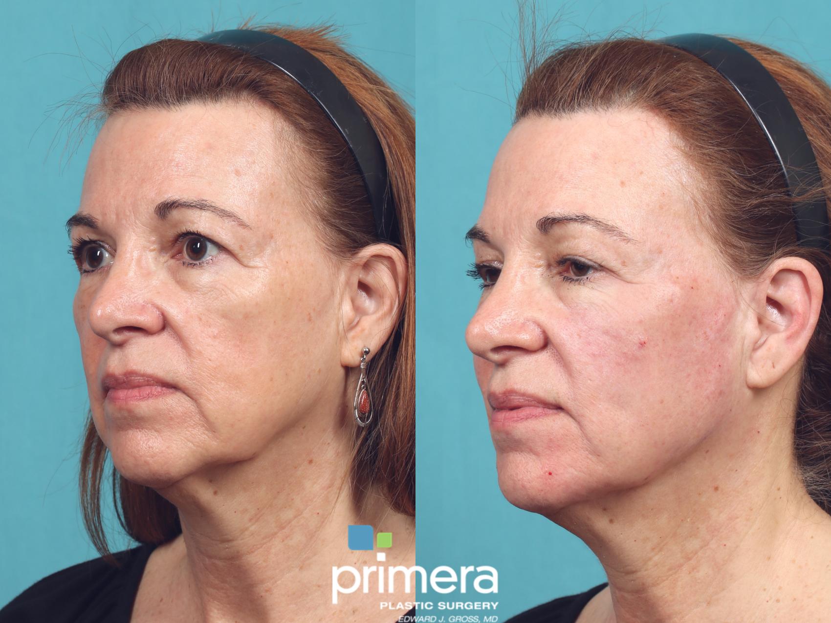 Before & After VOLUMA® Case 1006 Left Oblique View in Orlando, Winter Park & Tampa, Florida