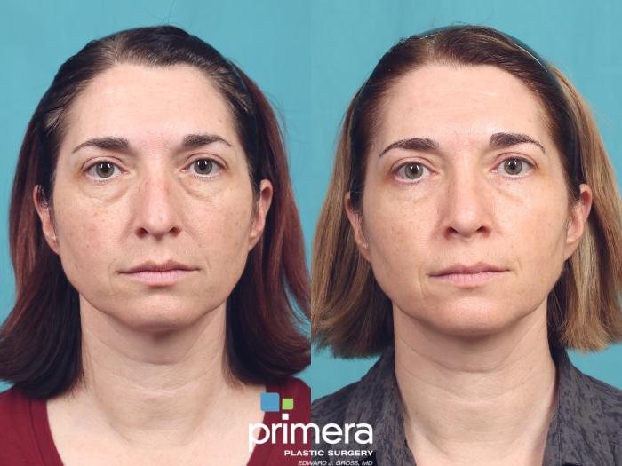 Before & After Blepharoplasty Case 1013 Front View in Orlando, Winter Park & Tampa, Florida
