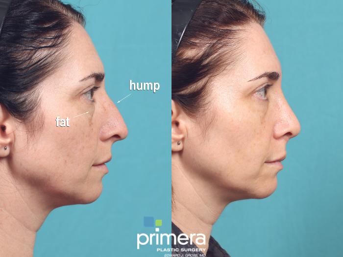 Before & After Blepharoplasty Case 1013 Right Side View in Orlando, Winter Park & Tampa, Florida